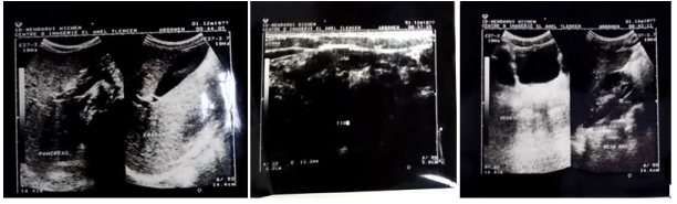  Figure 1: Abdominal ultrasound showing a gallbladder and free iliac fossa.