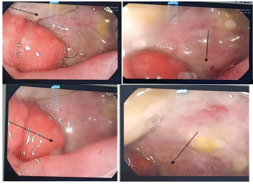  Figure 2: Esogastroduodenal fibroscopy (images A,B,C,D) showing an inflammatory bulb Site of an ulcer causing fibrous stenosis with impassable inflammatory reaction.