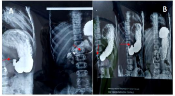  Figure 3: Esogastroduodenal transit Images A,B showing tight bulbar stenosis.