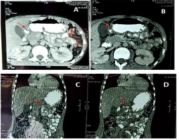  Figure 4A,B,C,D: Abdominal CT scan in sagittal section after injection of the contrast product post bulbar narrowing with an inflammatory appearance.