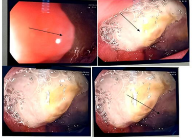 Figure 5A,B,C: Esogastroduodenal fibroscopy showing a bulb reduced in size, deformed by large congestive folds with ulcer and pigmented spots stage IIb Forrest.