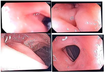 Figure 7: Esogastroduodenal fibroscopy (images A,B,C,D) healing of the bulbar ulcer.