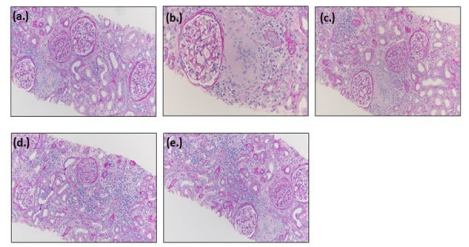 Figure 1: Biopsy Results of Patient #1.