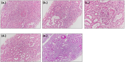 Figure 1: Biopsy Results of Patient #2.