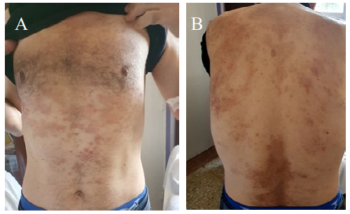 Figure 1: A) Psoriasis lesions in the thorax and abdomen image; B) Psoriasis lesions on the back.