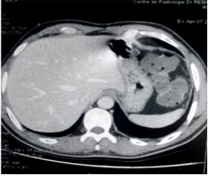  Figure 3: Abdominal CT in axial section, shows gastric thickening.