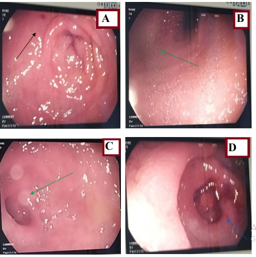 Figure 4: Esophagogastroduodenal fibroscopy.