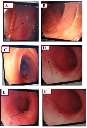 Figure 5: A,B,) Show a congestive colonic mucosa in places with an edematous appearance; D,E,F) Shows congestive rectal mucosa with multiple erosions.