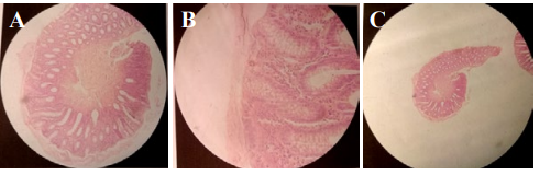 Figure 6: A,B,C) Rectal biopsy; H,E) Staining (Routine pathology lab staining).