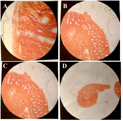 Figure 7: A,B,C,D) Rectal biopsy Congo red staining. Histological appearance suggests rectal amyloidosis.