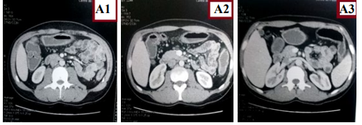 Figure 8: A1,A2,A3) Axial CT scan shows colonic thickening.