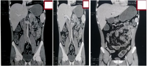 Figure 9: Frontal CT scan shows ileitis with diffuse colonic thickening.