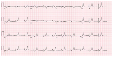  Figure 1: Peaked T waves due to hyperkalemia seen in Case #2