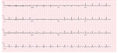 Figure 2: Resolution of EKG changes in Case #2 within 4 hours after foley catheter insertion and potassium lowering protocol.