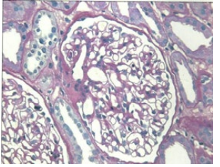 <strong>Figure 2A</strong>: Normo Cellular Glomerulus.