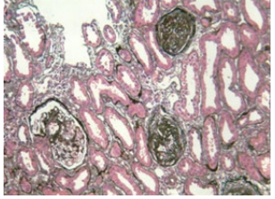 <strong>Figure 3C</strong>: Focal Glomerulosclerosis.