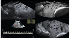 <strong>Figure 1</strong>: Signs in sonographic diagnostic criteria for morbidly adherent placenta, using Gray-scale and color Doppler images. (a) Clear space: loss/irregularity of echolucent area located between uterus and placenta (arrows). (b) Bladder line: thinning or interruption of hyperechoic interface between uterine serosa and bladder wall (arrows). (c,d) Placental lacunae with turbulent high-velocity flow (Adopted from CalÃ?Â??Ã?Â???Ã?Â??Ã?Â????Ã?Â??Ã?Â???Ã?Â??Ã?Â?????Ã?Â??Ã?Â???Ã?Â??Ã?Â????Ã?Â??Ã?Â???Ã?Â??Ã?Â??????Ã?Â??Ã?Â???Ã?Â??Ã?Â????Ã?Â??Ã?Â???Ã?Â??Ã?Â?????Ã?Â??Ã?Â???Ã?Â??Ã?Â????Ã?Â??Ã?Â???Ã?Â??Ã?Â???????Ã?Â??Ã?Â???Ã?Â??Ã?Â????Ã?Â??Ã?Â???Ã?Â??Ã?Â?????Ã?Â??Ã?Â???Ã?Â??Ã?Â????Ã?Â??Ã?Â???Ã?Â??Ã?Â??????Ã?Â??Ã?Â???Ã?Â??Ã?Â????Ã?Â??Ã?Â???Ã?Â??Ã?Â?????Ã?Â??Ã?Â???Ã?Â??Ã?Â????Ã?Â??Ã?Â???Ã?Â??Ã?Â????????Ã?Â??Ã?Â???Ã?Â??Ã?Â????Ã?Â??Ã?Â???Ã?Â??Ã?Â?????Ã?Â??Ã?Â???Ã?Â??Ã?Â????Ã?Â??Ã?Â???Ã?Â??Ã?Â??????Ã?Â??Ã?Â???Ã?Â??Ã?Â????Ã?Â??Ã?Â???Ã?Â??Ã?Â?????Ã?Â??Ã?Â???Ã?Â??Ã?Â????Ã?Â??Ã?Â???Ã?Â??Ã?Â???????Ã?Â??Ã?Â???Ã?Â??Ã?Â????Ã?Â??Ã?Â???Ã?Â??Ã?Â?????Ã?Â??Ã?Â???Ã?Â??Ã?Â????Ã?Â??Ã?Â???Ã?Â??Ã?Â??????Ã?Â??Ã?Â???Ã?Â??Ã?Â????Ã?Â??Ã?Â???Ã?Â??Ã?Â?????Ã?Â??Ã?Â???Ã?Â??Ã?Â????Ã?Â??Ã?Â???Ã?Â??Ã?Â?????????Ã?Â??Ã?Â???Ã?Â??Ã?Â????Ã?Â??Ã?Â???Ã?Â??Ã?Â?????Ã?Â??Ã?Â???Ã?Â??Ã?Â????Ã?Â??Ã?Â???Ã?Â??Ã?Â??????Ã?Â??Ã?Â???Ã?Â??Ã?Â????Ã?Â??Ã?Â???Ã?Â??Ã?Â?????Ã?Â??Ã?Â???Ã?Â??Ã?Â????Ã?Â??Ã?Â???Ã?Â??Ã?Â???????Ã?Â??Ã?Â???Ã?Â??Ã?Â????Ã?Â??Ã?Â???Ã?Â??Ã?Â?????Ã?Â??Ã?Â???Ã?Â??Ã?Â????Ã?Â??Ã?Â???Ã?Â??Ã?Â??????Ã?Â??Ã?Â???Ã?Â??Ã?Â????Ã?Â??Ã?Â???Ã?Â??Ã?Â?????Ã?Â??Ã?Â???Ã?Â??Ã?Â????Ã?Â??Ã?Â???Ã?Â??Ã?Â????????Ã?Â??Ã?Â???Ã?Â??Ã?Â????Ã?Â??Ã?Â???Ã?Â??Ã?Â?????Ã?Â??Ã?Â???Ã?Â??Ã?Â????Ã?Â??Ã?Â???Ã?Â??Ã?Â??????Ã?Â??Ã?Â???Ã?Â??Ã?Â????Ã?Â??Ã?Â???Ã?Â??Ã?Â?????Ã?Â??Ã?Â???Ã?Â??Ã?Â????Ã?Â??Ã?Â???Ã?Â??Ã?Â???????Ã?Â??Ã?Â???Ã?Â??Ã?Â????Ã?Â??Ã?Â???Ã?Â??Ã?Â?????Ã?Â??Ã?Â???Ã?Â??Ã?Â????Ã?Â??Ã?Â???Ã?Â??Ã?Â??????Ã?Â??Ã?Â???Ã?Â??Ã?Â????Ã?Â??Ã?Â???Ã?Â??Ã?Â?????Ã?Â??Ã?Â???Ã?Â??Ã?Â????Ã?Â??Ã?Â???Ã?Â??Ã?Â?????????Ã?Â??Ã?Â???Ã?Â??Ã?Â????Ã?Â??Ã?Â???Ã?Â??Ã?Â?????Ã?Â??Ã?Â???Ã?Â??Ã?Â????Ã?Â??Ã?Â???Ã?Â??Ã?Â??????Ã?Â??Ã?Â???Ã?Â??Ã?Â????Ã?Â??Ã?Â???Ã?Â??Ã?Â?????Ã?Â??Ã?Â???Ã?Â??Ã?Â????Ã?Â??Ã?Â???Ã?Â??Ã?Â???????Ã?Â??Ã?Â???Ã?Â??Ã?Â????Ã?Â??Ã?Â???Ã?Â??Ã?Â?????Ã?Â??Ã?Â???Ã?Â??Ã?Â????Ã?Â??Ã?Â???Ã?Â??Ã?Â??????Ã?Â??Ã?Â???Ã?Â??Ã?Â????Ã?Â??Ã?Â???Ã?Â??Ã?Â?????Ã?Â??Ã?Â???Ã?Â??Ã?Â????Ã?Â??Ã?Â???Ã?Â??Ã?Â????????Ã?Â??Ã?Â???Ã?Â??Ã?Â????Ã?Â??Ã?Â???Ã?Â??Ã?Â?????Ã?Â??Ã?Â???Ã?Â??Ã?Â????Ã?Â??Ã?Â???Ã?Â??Ã?Â??????Ã?Â??Ã?Â???Ã?Â??Ã?Â????Ã?Â??Ã?Â???Ã?Â??Ã?Â?????Ã?Â??Ã?Â???Ã?Â??Ã?Â????Ã?Â??Ã?Â???Ã?Â??Ã?Â???????Ã?Â??Ã?Â???Ã?Â??Ã?Â????Ã?Â??Ã?Â???Ã?Â??Ã?Â?????Ã?Â??Ã?Â???Ã?Â??Ã?Â????Ã?Â??Ã?Â???Ã?Â??Ã?Â??????Ã?Â??Ã?Â???Ã?Â??Ã?Â????Ã?Â??Ã?Â???Ã?Â??Ã?Â?????Ã?Â??Ã?Â???Ã?Â??Ã?Â????Ã?Â??Ã?Â???Ã?Â??Ã?Â?????????Ã?Â??Ã?Â???Ã?Â??Ã?Â????Ã?Â??Ã?Â???Ã?Â??Ã?Â?????Ã?Â??Ã?Â???Ã?Â??Ã?Â????Ã?Â??Ã?Â???Ã?Â??Ã?Â??????Ã?Â??Ã?Â???Ã?Â??Ã?Â????Ã?Â??Ã?Â???Ã?Â??Ã?Â?????Ã?Â??Ã?Â???Ã?Â??Ã?Â????Ã?Â??Ã?Â???Ã?Â??Ã?Â???????Ã?Â??Ã?Â???Ã?Â??Ã?Â????Ã?Â??Ã?Â???Ã?Â??Ã?Â?????Ã?Â??Ã?Â???Ã?Â??Ã?Â????Ã?Â??Ã?Â???Ã?Â??Ã?Â??????Ã?Â??Ã?Â???Ã?Â??Ã?Â????Ã?Â??Ã?Â???Ã?Â??Ã?Â?????Ã?Â??Ã?Â???Ã?Â??Ã?Â????Ã?Â??Ã?Â???Ã?Â??Ã?Â????????Ã?Â??Ã?Â???Ã?Â??Ã?Â????Ã?Â??Ã?Â???Ã?Â??Ã?Â?????Ã?Â??Ã?Â???Ã?Â??Ã?Â????Ã?Â??Ã?Â???Ã?Â??Ã?Â??????Ã?Â??Ã?Â???Ã?Â??Ã?Â????Ã?Â??Ã?Â???Ã?Â??Ã?Â?????Ã?Â??Ã?Â???Ã?Â??Ã?Â????Ã?Â??Ã?Â???Ã?Â??Ã?Â???????Ã?Â??Ã?Â???Ã?Â??Ã?Â????Ã?Â??Ã?Â???Ã?Â??Ã?Â?????Ã?Â??Ã?Â???Ã?Â??Ã?Â????Ã?Â??Ã?Â???Ã?Â??Ã?Â??????Ã?Â??Ã?Â???Ã?Â??Ã?Â????Ã?Â??Ã?Â???Ã?Â??Ã?Â?????Ã?Â??Ã?Â???Ã?Â??Ã?Â????Ã?Â??Ã?Â???Ã?Â??Ã?Â????????Ã?Â??Ã?Â???Ã?Â??Ã?Â????Ã?Â??Ã?Â???Ã?Â??Ã?Â?????Ã?Â??Ã?Â???Ã?Â??Ã?Â????Ã?Â??Ã?Â???Ã?Â??Ã?Â??????Ã?Â??Ã?Â???Ã?Â??Ã?Â????Ã?Â??Ã?Â???Ã?Â??Ã?Â?????Ã?Â??Ã?Â???Ã?Â??Ã?Â????Ã?Â??Ã?Â???Ã?Â??Ã?Â???????Ã?Â??Ã?Â???Ã?Â??Ã?Â????Ã?Â??Ã?Â???Ã?Â??Ã?Â?????Ã?Â??Ã?Â???Ã?Â??Ã?Â????Ã?Â??Ã?Â???Ã?Â??Ã?Â??????Ã?Â??Ã?Â???Ã?Â??Ã?Â????Ã?Â??Ã?Â???Ã?Â??Ã?Â?????Ã?Â??Ã?Â???Ã?Â??Ã?Â????Ã?Â??Ã?Â???Ã?Â??Ã?Â????????Ã?Â??Ã?Â???Ã?Â??Ã?Â????Ã?Â??Ã?Â???Ã?Â??Ã?Â?????Ã?Â??Ã?Â???Ã?Â??Ã?Â????Ã?Â??Ã?Â???Ã?Â??Ã?Â??????Ã?Â??Ã?Â???Ã?Â??Ã?Â????Ã?Â??Ã?Â???Ã?Â??Ã?Â?????Ã?Â??Ã?Â???Ã?Â??Ã?Â????Ã?Â??Ã?Â???Ã?Â??Ã?Â???????Ã?Â??Ã?Â???Ã?Â??Ã?Â????Ã?Â??Ã?Â???Ã?Â??Ã?Â?????Ã?Â??Ã?Â???Ã?Â??Ã?Â????Ã?Â??Ã?Â???Ã?Â??Ã?Â??????Ã?Â??Ã?Â???Ã?Â??Ã?Â????Ã?Â??Ã?Â???Ã?Â??Ã?Â?????Ã?Â??Ã?Â???Ã?Â??Ã?Â????Ã?Â??Ã?Â???Ã?Â??Ã?Â???????Ã?Â??Ã?Â???Ã?Â??Ã?Â????Ã?Â??Ã?Â???Ã?Â??Ã?Â?????Ã?Â??Ã?Â???Ã?Â??Ã?Â????Ã?Â??Ã?Â???Ã?Â??Ã?Â??????Ã?Â??Ã?Â???Ã?Â??Ã?Â????Ã?Â??Ã?Â???Ã?Â??Ã?Â?????Ã?Â??Ã?Â???Ã?Â??Ã?Â????Ã?Â??Ã?Â???Ã?Â??Ã?Â???????Ã?Â??Ã?Â???Ã?Â??Ã?Â????Ã?Â??Ã?Â???Ã?Â??Ã?Â?????Ã?Â??Ã?Â???Ã?Â??Ã?Â????Ã?Â??Ã?Â???Ã?Â??Ã?Â??????Ã?Â??Ã?Â???Ã?Â??Ã?Â????Ã?Â??Ã?Â???Ã?Â??Ã?Â?????Ã?Â??Ã?Â???Ã?Â??Ã?Â????Ã?Â??Ã?Â???Ã?Â??Ã?Â??????Ã?Â??Ã?Â???Ã?Â??Ã?Â????Ã?Â??Ã?Â???Ã?Â??Ã?Â?????Ã?Â??Ã?Â???Ã?Â??Ã?Â????Ã?Â??Ã?Â???Ã?Â??Ã?Â??????Ã?Â??Ã?Â???Ã?Â??Ã?Â????Ã?Â??Ã?Â???Ã?Â??Ã?Â?????Ã?Â??Ã?Â???Ã?Â??Ã?Â????Ã?Â??Ã?Â???Ã?Â??Ã?Â?????Ã?Â??Ã?Â???Ã?Â??Ã?Â????Ã?Â??Ã?Â???Ã?Â??Ã?Â?????Ã?Â??Ã?Â???Ã?Â??Ã?Â????Ã?Â??Ã?Â???Ã?Â??Ã?Â????Ã?Â??Ã?Â???Ã?Â??Ã?Â????Ã?Â??Ã?Â???Ã?Â??Ã?Â???Ã?Â??Ã?Â???Ã?Â??Ã?Â??Ã?Â??Ã?Â?Ã?Â¬ G et al. 2013[40]).