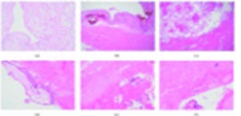 <strong>Figure 2</strong>: Histopathology of PAS. (a) High-power picture of decidualised endometrium as a result of pregnancy. Stromal cells are large, pale, and polygonal. (b) Low-power image of decidualised endometrium on the surface with underlying congested myometrial blood vessels and myometrium. (c) Lowpower image of PAS showing chorionic villi in direct contact with myometrium (no intervening decidua). (d) Chorionic villus with polar trophoblast invading myometrial muscle. (e) Non-adherent area of the same placenta where decidua is seen between villi (bottom right) and myometrium (top left). (f) PASchorionic villi in direct contact with muscle; a multinucleated extravillous trophoblast is seen in the top right. Adopted from Bartels HC, et al. 2018 [48], an open access article distributed under the Creative Commons Attribution License.