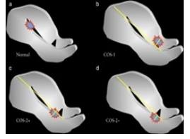  <strong>Figure 3</strong>: Diagrammatic representation of relationship between ectopic gestational sac, Cesarean scar (CS) and anterior uterine wall, defined as Ã?Â??Ã?Â???Ã?Â??Ã?Â????Ã?Â??Ã?Â???Ã?Â??Ã?Â?????Ã?Â??Ã?Â???Ã?Â??Ã?Â????Ã?Â??Ã?Â???Ã?Â??Ã?Â??????Ã?Â??Ã?Â???Ã?Â??Ã?Â????Ã?Â??Ã?Â???Ã?Â??Ã?Â?????Ã?Â??Ã?Â???Ã?Â??Ã?Â????Ã?Â??Ã?Â???Ã?Â??Ã?Â???????Ã?Â??Ã?Â???Ã?Â??Ã?Â????Ã?Â??Ã?Â???Ã?Â??Ã?Â?????Ã?Â??Ã?Â???Ã?Â??Ã?Â????Ã?Â??Ã?Â???Ã?Â??Ã?Â??????Ã?Â??Ã?Â???Ã?Â??Ã?Â????Ã?Â??Ã?Â???Ã?Â??Ã?Â?????Ã?Â??Ã?Â???Ã?Â??Ã?Â????Ã?Â??Ã?Â???Ã?Â??Ã?Â????????Ã?Â??Ã?Â???Ã?Â??Ã?Â????Ã?Â??Ã?Â???Ã?Â??Ã?Â?????Ã?Â??Ã?Â???Ã?Â??Ã?Â????Ã?Â??Ã?Â???Ã?Â??Ã?Â??????Ã?Â??Ã?Â???Ã?Â??Ã?Â????Ã?Â??Ã?Â???Ã?Â??Ã?Â?????Ã?Â??Ã?Â???Ã?Â??Ã?Â????Ã?Â??Ã?Â???Ã?Â??Ã?Â???????Ã?Â??Ã?Â???Ã?Â??Ã?Â????Ã?Â??Ã?Â???Ã?Â??Ã?Â?????Ã?Â??Ã?Â???Ã?Â??Ã?Â????Ã?Â??Ã?Â???Ã?Â??Ã?Â??????Ã?Â??Ã?Â???Ã?Â??Ã?Â????Ã?Â??Ã?Â???Ã?Â??Ã?Â?????Ã?Â??Ã?Â???Ã?Â??Ã?Â????Ã?Â??Ã?Â???Ã?Â??Ã?Â?????????Ã?Â??Ã?Â???Ã?Â??Ã?Â????Ã?Â??Ã?Â???Ã?Â??Ã?Â?????Ã?Â??Ã?Â???Ã?Â??Ã?Â????Ã?Â??Ã?Â???Ã?Â??Ã?Â??????Ã?Â??Ã?Â???Ã?Â??Ã?Â????Ã?Â??Ã?Â???Ã?Â??Ã?Â?????Ã?Â??Ã?Â???Ã?Â??Ã?Â????Ã?Â??Ã?Â???Ã?Â??Ã?Â???????Ã?Â??Ã?Â???Ã?Â??Ã?Â????Ã?Â??Ã?Â???Ã?Â??Ã?Â?????Ã?Â??Ã?Â???Ã?Â??Ã?Â????Ã?Â??Ã?Â???Ã?Â??Ã?Â??????Ã?Â??Ã?Â???Ã?Â??Ã?Â????Ã?Â??Ã?Â???Ã?Â??Ã?Â?????Ã?Â??Ã?Â???Ã?Â??Ã?Â????Ã?Â??Ã?Â???Ã?Â??Ã?Â????????Ã?Â??Ã?Â???Ã?Â??Ã?Â????Ã?Â??Ã?Â???Ã?Â??Ã?Â?????Ã?Â??Ã?Â???Ã?Â??Ã?Â????Ã?Â??Ã?Â???Ã?Â??Ã?Â??????Ã?Â??Ã?Â???Ã?Â??Ã?Â????Ã?Â??Ã?Â???Ã?Â??Ã?Â?????Ã?Â??Ã?Â???Ã?Â??Ã?Â????Ã?Â??Ã?Â???Ã?Â??Ã?Â???????Ã?Â??Ã?Â???Ã?Â??Ã?Â????Ã?Â??Ã?Â???Ã?Â??Ã?Â?????Ã?Â??Ã?Â???Ã?Â??Ã?Â????Ã?Â??Ã?Â???Ã?Â??Ã?Â??????Ã?Â??Ã?Â???Ã?Â??Ã?Â????Ã?Â??Ã?Â???Ã?Â??Ã?Â?????Ã?Â??Ã?Â???Ã?Â??Ã?Â????Ã?Â??Ã?Â???Ã?Â??Ã?Â????????Ã?Â??Ã?Â???Ã?Â??Ã?Â????Ã?Â??Ã?Â???Ã?Â??Ã?Â?????Ã?Â??Ã?Â???Ã?Â??Ã?Â????Ã?Â??Ã?Â???Ã?Â??Ã?Â??????Ã?Â??Ã?Â???Ã?Â??Ã?Â????Ã?Â??Ã?Â???Ã?Â??Ã?Â?????Ã?Â??Ã?Â???Ã?Â??Ã?Â????Ã?Â??Ã?Â???Ã?Â??Ã?Â???????Ã?Â??Ã?Â???Ã?Â??Ã?Â????Ã?Â??Ã?Â???Ã?Â??Ã?Â?????Ã?Â??Ã?Â???Ã?Â??Ã?Â????Ã?Â??Ã?Â???Ã?Â??Ã?Â??????Ã?Â??Ã?Â???Ã?Â??Ã?Â????Ã?Â??Ã?Â???Ã?Â??Ã?Â?????Ã?Â??Ã?Â???Ã?Â??Ã?Â????Ã?Â??Ã?Â???Ã?Â??Ã?Â????????Ã?Â??Ã?Â???Ã?Â??Ã?Â????Ã?Â??Ã?Â???Ã?Â??Ã?Â?????Ã?Â??Ã?Â???Ã?Â??Ã?Â????Ã?Â??Ã?Â???Ã?Â??Ã?Â??????Ã?Â??Ã?Â???Ã?Â??Ã?Â????Ã?Â??Ã?Â???Ã?Â??Ã?Â?????Ã?Â??Ã?Â???Ã?Â??Ã?Â????Ã?Â??Ã?Â???Ã?Â??Ã?Â???????Ã?Â??Ã?Â???Ã?Â??Ã?Â????Ã?Â??Ã?Â???Ã?Â??Ã?Â?????Ã?Â??Ã?Â???Ã?Â??Ã?Â????Ã?Â??Ã?Â???Ã?Â??Ã?Â??????Ã?Â??Ã?Â???Ã?Â??Ã?Â????Ã?Â??Ã?Â???Ã?Â??Ã?Â?????Ã?Â??Ã?Â???Ã?Â??Ã?Â????Ã?Â??Ã?Â???Ã?Â??Ã?Â???????Ã?Â??Ã?Â???Ã?Â??Ã?Â????Ã?Â??Ã?Â???Ã?Â??Ã?Â?????Ã?Â??Ã?Â???Ã?Â??Ã?Â????Ã?Â??Ã?Â???Ã?Â??Ã?Â??????Ã?Â??Ã?Â???Ã?Â??Ã?Â????Ã?Â??Ã?Â???Ã?Â??Ã?Â?????Ã?Â??Ã?Â???Ã?Â??Ã?Â????Ã?Â??Ã?Â???Ã?Â??Ã?Â???????Ã?Â??Ã?Â???Ã?Â??Ã?Â????Ã?Â??Ã?Â???Ã?Â??Ã?Â?????Ã?Â??Ã?Â???Ã?Â??Ã?Â????Ã?Â??Ã?Â???Ã?Â??Ã?Â??????Ã?Â??Ã?Â???Ã?Â??Ã?Â????Ã?Â??Ã?Â???Ã?Â??Ã?Â?????Ã?Â??Ã?Â???Ã?Â??Ã?Â????Ã?Â??Ã?Â???Ã?Â??Ã?Â??????Ã?Â??Ã?Â???Ã?Â??Ã?Â????Ã?Â??Ã?Â???Ã?Â??Ã?Â?????Ã?Â??Ã?Â???Ã?Â??Ã?Â????Ã?Â??Ã?Â???Ã?Â??Ã?Â??????Ã?Â??Ã?Â???Ã?Â??Ã?Â????Ã?Â??Ã?Â???Ã?Â??Ã?Â?????Ã?Â??Ã?Â???Ã?Â??Ã?Â????Ã?Â??Ã?Â???Ã?Â??Ã?Â?????Ã?Â??Ã?Â???Ã?Â??Ã?Â????Ã?Â??Ã?Â???Ã?Â??Ã?Â?????Ã?Â??Ã?Â???Ã?Â??Ã?Â????Ã?Â??Ã?Â???Ã?Â??Ã?Â????Ã?Â??Ã?Â???Ã?Â??Ã?Â????Ã?Â??Ã?Â???Ã?Â??Ã?Â???Ã?Â??Ã?Â???Ã?Â??Ã?Â??Ã?Â??Ã?Â?Ã?Â¢??crossover sign (COS)Ã?Â??Ã?Â???Ã?Â??Ã?Â????Ã?Â??Ã?Â???Ã?Â??Ã?Â?????Ã?Â??Ã?Â???Ã?Â??Ã?Â????Ã?Â??Ã?Â???Ã?Â??Ã?Â??????Ã?Â??Ã?Â???Ã?Â??Ã?Â????Ã?Â??Ã?Â???Ã?Â??Ã?Â?????Ã?Â??Ã?Â???Ã?Â??Ã?Â????Ã?Â??Ã?Â???Ã?Â??Ã?Â???????Ã?Â??Ã?Â???Ã?Â??Ã?Â????Ã?Â??Ã?Â???Ã?Â??Ã?Â?????Ã?Â??Ã?Â???Ã?Â??Ã?Â????Ã?Â??Ã?Â???Ã?Â??Ã?Â??????Ã?Â??Ã?Â???Ã?Â??Ã?Â????Ã?Â??Ã?Â???Ã?Â??Ã?Â?????Ã?Â??Ã?Â???Ã?Â??Ã?Â????Ã?Â??Ã?Â???Ã?Â??Ã?Â????????Ã?Â??Ã?Â???Ã?Â??Ã?Â????Ã?Â??Ã?Â???Ã?Â??Ã?Â?????Ã?Â??Ã?Â???Ã?Â??Ã?Â????Ã?Â??Ã?Â???Ã?Â??Ã?Â??????Ã?Â??Ã?Â???Ã?Â??Ã?Â????Ã?Â??Ã?Â???Ã?Â??Ã?Â?????Ã?Â??Ã?Â???Ã?Â??Ã?Â????Ã?Â??Ã?Â???Ã?Â??Ã?Â???????Ã?Â??Ã?Â???Ã?Â??Ã?Â????Ã?Â??Ã?Â???Ã?Â??Ã?Â?????Ã?Â??Ã?Â???Ã?Â??Ã?Â????Ã?Â??Ã?Â???Ã?Â??Ã?Â??????Ã?Â??Ã?Â???Ã?Â??Ã?Â????Ã?Â??Ã?Â???Ã?Â??Ã?Â?????Ã?Â??Ã?Â???Ã?Â??Ã?Â????Ã?Â??Ã?Â???Ã?Â??Ã?Â?????????Ã?Â??Ã?Â???Ã?Â??Ã?Â????Ã?Â??Ã?Â???Ã?Â??Ã?Â?????Ã?Â??Ã?Â???Ã?Â??Ã?Â????Ã?Â??Ã?Â???Ã?Â??Ã?Â??????Ã?Â??Ã?Â???Ã?Â??Ã?Â????Ã?Â??Ã?Â???Ã?Â??Ã?Â?????Ã?Â??Ã?Â???Ã?Â??Ã?Â????Ã?Â??Ã?Â???Ã?Â??Ã?Â???????Ã?Â??Ã?Â???Ã?Â??Ã?Â????Ã?Â??Ã?Â???Ã?Â??Ã?Â?????Ã?Â??Ã?Â???Ã?Â??Ã?Â????Ã?Â??Ã?Â???Ã?Â??Ã?Â??????Ã?Â??Ã?Â???Ã?Â??Ã?Â????Ã?Â??Ã?Â???Ã?Â??Ã?Â?????Ã?Â??Ã?Â???Ã?Â??Ã?Â????Ã?Â??Ã?Â???Ã?Â??Ã?Â????????Ã?Â??Ã?Â???Ã?Â??Ã?Â????Ã?Â??Ã?Â???Ã?Â??Ã?Â?????Ã?Â??Ã?Â???Ã?Â??Ã?Â????Ã?Â??Ã?Â???Ã?Â??Ã?Â??????Ã?Â??Ã?Â???Ã?Â??Ã?Â????Ã?Â??Ã?Â???Ã?Â??Ã?Â?????Ã?Â??Ã?Â???Ã?Â??Ã?Â????Ã?Â??Ã?Â???Ã?Â??Ã?Â???????Ã?Â??Ã?Â???Ã?Â??Ã?Â????Ã?Â??Ã?Â???Ã?Â??Ã?Â?????Ã?Â??Ã?Â???Ã?Â??Ã?Â????Ã?Â??Ã?Â???Ã?Â??Ã?Â??????Ã?Â??Ã?Â???Ã?Â??Ã?Â????Ã?Â??Ã?Â???Ã?Â??Ã?Â?????Ã?Â??Ã?Â???Ã?Â??Ã?Â????Ã?Â??Ã?Â???Ã?Â??Ã?Â????????Ã?Â??Ã?Â???Ã?Â??Ã?Â????Ã?Â??Ã?Â???Ã?Â??Ã?Â?????Ã?Â??Ã?Â???Ã?Â??Ã?Â????Ã?Â??Ã?Â???Ã?Â??Ã?Â??????Ã?Â??Ã?Â???Ã?Â??Ã?Â????Ã?Â??Ã?Â???Ã?Â??Ã?Â?????Ã?Â??Ã?Â???Ã?Â??Ã?Â????Ã?Â??Ã?Â???Ã?Â??Ã?Â???????Ã?Â??Ã?Â???Ã?Â??Ã?Â????Ã?Â??Ã?Â???Ã?Â??Ã?Â?????Ã?Â??Ã?Â???Ã?Â??Ã?Â????Ã?Â??Ã?Â???Ã?Â??Ã?Â??????Ã?Â??Ã?Â???Ã?Â??Ã?Â????Ã?Â??Ã?Â???Ã?Â??Ã?Â?????Ã?Â??Ã?Â???Ã?Â??Ã?Â????Ã?Â??Ã?Â???Ã?Â??Ã?Â????????Ã?Â??Ã?Â???Ã?Â??Ã?Â????Ã?Â??Ã?Â???Ã?Â??Ã?Â?????Ã?Â??Ã?Â???Ã?Â??Ã?Â????Ã?Â??Ã?Â???Ã?Â??Ã?Â??????Ã?Â??Ã?Â???Ã?Â??Ã?Â????Ã?Â??Ã?Â???Ã?Â??Ã?Â?????Ã?Â??Ã?Â???Ã?Â??Ã?Â????Ã?Â??Ã?Â???Ã?Â??Ã?Â???????Ã?Â??Ã?Â???Ã?Â??Ã?Â????Ã?Â??Ã?Â???Ã?Â??Ã?Â?????Ã?Â??Ã?Â???Ã?Â??Ã?Â????Ã?Â??Ã?Â???Ã?Â??Ã?Â??????Ã?Â??Ã?Â???Ã?Â??Ã?Â????Ã?Â??Ã?Â???Ã?Â??Ã?Â?????Ã?Â??Ã?Â???Ã?Â??Ã?Â????Ã?Â??Ã?Â???Ã?Â??Ã?Â???????Ã?Â??Ã?Â???Ã?Â??Ã?Â????Ã?Â??Ã?Â???Ã?Â??Ã?Â?????Ã?Â??Ã?Â???Ã?Â??Ã?Â????Ã?Â??Ã?Â???Ã?Â??Ã?Â??????Ã?Â??Ã?Â???Ã?Â??Ã?Â????Ã?Â??Ã?Â???Ã?Â??Ã?Â?????Ã?Â??Ã?Â???Ã?Â??Ã?Â????Ã?Â??Ã?Â???Ã?Â??Ã?Â???????Ã?Â??Ã?Â???Ã?Â??Ã?Â????Ã?Â??Ã?Â???Ã?Â??Ã?Â?????Ã?Â??Ã?Â???Ã?Â??Ã?Â????Ã?Â??Ã?Â???Ã?Â??Ã?Â??????Ã?Â??Ã?Â???Ã?Â??Ã?Â????Ã?Â??Ã?Â???Ã?Â??Ã?Â?????Ã?Â??Ã?Â???Ã?Â??Ã?Â????Ã?Â??Ã?Â???Ã?Â??Ã?Â??????Ã?Â??Ã?Â???Ã?Â??Ã?Â????Ã?Â??Ã?Â???Ã?Â??Ã?Â?????Ã?Â??Ã?Â???Ã?Â??Ã?Â????Ã?Â??Ã?Â???Ã?Â??Ã?Â??????Ã?Â??Ã?Â???Ã?Â??Ã?Â????Ã?Â??Ã?Â???Ã?Â??Ã?Â?????Ã?Â??Ã?Â???Ã?Â??Ã?Â????Ã?Â??Ã?Â???Ã?Â??Ã?Â?????Ã?Â??Ã?Â???Ã?Â??Ã?Â????Ã?Â??Ã?Â???Ã?Â??Ã?Â?????Ã?Â??Ã?Â???Ã?Â??Ã?Â????Ã?Â??Ã?Â???Ã?Â??Ã?Â????Ã?Â??Ã?Â???Ã?Â??Ã?Â????Ã?Â??Ã?Â???Ã?Â??Ã?Â???Ã?Â??Ã?Â???Ã?Â??Ã?Â??Ã?Â??Ã?Â?Ã?Â¢?? in MAP. In sagittal view of uterus, a straight line is drawn connecting internal cervical os and uterine fundus through endometrium (endometrial line; long yellow line). Gestational sac is identified and superiorÃ?Â??Ã?Â???Ã?Â??Ã?Â????Ã?Â??Ã?Â???Ã?Â??Ã?Â?????Ã?Â??Ã?Â???Ã?Â??Ã?Â????Ã?Â??Ã?Â???Ã?Â??Ã?Â??????Ã?Â??Ã?Â???Ã?Â??Ã?Â????Ã?Â??Ã?Â???Ã?Â??Ã?Â?????Ã?Â??Ã?Â???Ã?Â??Ã?Â????Ã?Â??Ã?Â???Ã?Â??Ã?Â???????Ã?Â??Ã?Â???Ã?Â??Ã?Â????Ã?Â??Ã?Â???Ã?Â??Ã?Â?????Ã?Â??Ã?Â???Ã?Â??Ã?Â????Ã?Â??Ã?Â???Ã?Â??Ã?Â??????Ã?Â??Ã?Â???Ã?Â??Ã?Â????Ã?Â??Ã?Â???Ã?Â??Ã?Â?????Ã?Â??Ã?Â???Ã?Â??Ã?Â????Ã?Â??Ã?Â???Ã?Â??Ã?Â????????Ã?Â??Ã?Â???Ã?Â??Ã?Â????Ã?Â??Ã?Â???Ã?Â??Ã?Â?????Ã?Â??Ã?Â???Ã?Â??Ã?Â????Ã?Â??Ã?Â???Ã?Â??Ã?Â??????Ã?Â??Ã?Â???Ã?Â??Ã?Â????Ã?Â??Ã?Â???Ã?Â??Ã?Â?????Ã?Â??Ã?Â???Ã?Â??Ã?Â????Ã?Â??Ã?Â???Ã?Â??Ã?Â???????Ã?Â??Ã?Â???Ã?Â??Ã?Â????Ã?Â??Ã?Â???Ã?Â??Ã?Â?????Ã?Â??Ã?Â???Ã?Â??Ã?Â????Ã?Â??Ã?Â???Ã?Â??Ã?Â??????Ã?Â??Ã?Â???Ã?Â??Ã?Â????Ã?Â??Ã?Â???Ã?Â??Ã?Â?????Ã?Â??Ã?Â???Ã?Â??Ã?Â????Ã?Â??Ã?Â???Ã?Â??Ã?Â?????????Ã?Â??Ã?Â???Ã?Â??Ã?Â????Ã?Â??Ã?Â???Ã?Â??Ã?Â?????Ã?Â??Ã?Â???Ã?Â??Ã?Â????Ã?Â??Ã?Â???Ã?Â??Ã?Â??????Ã?Â??Ã?Â???Ã?Â??Ã?Â????Ã?Â??Ã?Â???Ã?Â??Ã?Â?????Ã?Â??Ã?Â???Ã?Â??Ã?Â????Ã?Â??Ã?Â???Ã?Â??Ã?Â???????Ã?Â??Ã?Â???Ã?Â??Ã?Â????Ã?Â??Ã?Â???Ã?Â??Ã?Â?????Ã?Â??Ã?Â???Ã?Â??Ã?Â????Ã?Â??Ã?Â???Ã?Â??Ã?Â??????Ã?Â??Ã?Â???Ã?Â??Ã?Â????Ã?Â??Ã?Â???Ã?Â??Ã?Â?????Ã?Â??Ã?Â???Ã?Â??Ã?Â????Ã?Â??Ã?Â???Ã?Â??Ã?Â????????Ã?Â??Ã?Â???Ã?Â??Ã?Â????Ã?Â??Ã?Â???Ã?Â??Ã?Â?????Ã?Â??Ã?Â???Ã?Â??Ã?Â????Ã?Â??Ã?Â???Ã?Â??Ã?Â??????Ã?Â??Ã?Â???Ã?Â??Ã?Â????Ã?Â??Ã?Â???Ã?Â??Ã?Â?????Ã?Â??Ã?Â???Ã?Â??Ã?Â????Ã?Â??Ã?Â???Ã?Â??Ã?Â???????Ã?Â??Ã?Â???Ã?Â??Ã?Â????Ã?Â??Ã?Â???Ã?Â??Ã?Â?????Ã?Â??Ã?Â???Ã?Â??Ã?Â????Ã?Â??Ã?Â???Ã?Â??Ã?Â??????Ã?Â??Ã?Â???Ã?Â??Ã?Â????Ã?Â??Ã?Â???Ã?Â??Ã?Â?????Ã?Â??Ã?Â???Ã?Â??Ã?Â????Ã?Â??Ã?Â???Ã?Â??Ã?Â????????Ã?Â??Ã?Â???Ã?Â??Ã?Â????Ã?Â??Ã?Â???Ã?Â??Ã?Â?????Ã?Â??Ã?Â???Ã?Â??Ã?Â????Ã?Â??Ã?Â???Ã?Â??Ã?Â??????Ã?Â??Ã?Â???Ã?Â??Ã?Â????Ã?Â??Ã?Â???Ã?Â??Ã?Â?????Ã?Â??Ã?Â???Ã?Â??Ã?Â????Ã?Â??Ã?Â???Ã?Â??Ã?Â???????Ã?Â??Ã?Â???Ã?Â??Ã?Â????Ã?Â??Ã?Â???Ã?Â??Ã?Â?????Ã?Â??Ã?Â???Ã?Â??Ã?Â????Ã?Â??Ã?Â???Ã?Â??Ã?Â??????Ã?Â??Ã?Â???Ã?Â??Ã?Â????Ã?Â??Ã?Â???Ã?Â??Ã?Â?????Ã?Â??Ã?Â???Ã?Â??Ã?Â????Ã?Â??Ã?Â???Ã?Â??Ã?Â????????Ã?Â??Ã?Â???Ã?Â??Ã?Â????Ã?Â??Ã?Â???Ã?Â??Ã?Â?????Ã?Â??Ã?Â???Ã?Â??Ã?Â????Ã?Â??Ã?Â???Ã?Â??Ã?Â??????Ã?Â??Ã?Â???Ã?Â??Ã?Â????Ã?Â??Ã?Â???Ã?Â??Ã?Â?????Ã?Â??Ã?Â???Ã?Â??Ã?Â????Ã?Â??Ã?Â???Ã?Â??Ã?Â???????Ã?Â??Ã?Â???Ã?Â??Ã?Â????Ã?Â??Ã?Â???Ã?Â??Ã?Â?????Ã?Â??Ã?Â???Ã?Â??Ã?Â????Ã?Â??Ã?Â???Ã?Â??Ã?Â??????Ã?Â??Ã?Â???Ã?Â??Ã?Â????Ã?Â??Ã?Â???Ã?Â??Ã?Â?????Ã?Â??Ã?Â???Ã?Â??Ã?Â????Ã?Â??Ã?Â???Ã?Â??Ã?Â???????Ã?Â??Ã?Â???Ã?Â??Ã?Â????Ã?Â??Ã?Â???Ã?Â??Ã?Â?????Ã?Â??Ã?Â???Ã?Â??Ã?Â????Ã?Â??Ã?Â???Ã?Â??Ã?Â??????Ã?Â??Ã?Â???Ã?Â??Ã?Â????Ã?Â??Ã?Â???Ã?Â??Ã?Â?????Ã?Â??Ã?Â???Ã?Â??Ã?Â????Ã?Â??Ã?Â???Ã?Â??Ã?Â???????Ã?Â??Ã?Â???Ã?Â??Ã?Â????Ã?Â??Ã?Â???Ã?Â??Ã?Â?????Ã?Â??Ã?Â???Ã?Â??Ã?Â????Ã?Â??Ã?Â???Ã?Â??Ã?Â??????Ã?Â??Ã?Â???Ã?Â??Ã?Â????Ã?Â??Ã?Â???Ã?Â??Ã?Â?????Ã?Â??Ã?Â???Ã?Â??Ã?Â????Ã?Â??Ã?Â???Ã?Â??Ã?Â??????Ã?Â??Ã?Â???Ã?Â??Ã?Â????Ã?Â??Ã?Â???Ã?Â??Ã?Â?????Ã?Â??Ã?Â???Ã?Â??Ã?Â????Ã?Â??Ã?Â???Ã?Â??Ã?Â??????Ã?Â??Ã?Â???Ã?Â??Ã?Â????Ã?Â??Ã?Â???Ã?Â??Ã?Â?????Ã?Â??Ã?Â???Ã?Â??Ã?Â????Ã?Â??Ã?Â???Ã?Â??Ã?Â?????Ã?Â??Ã?Â???Ã?Â??Ã?Â????Ã?Â??Ã?Â???Ã?Â??Ã?Â?????Ã?Â??Ã?Â???Ã?Â??Ã?Â????Ã?Â??Ã?Â???Ã?Â??Ã?Â????Ã?Â??Ã?Â???Ã?Â??Ã?Â????Ã?Â??Ã?Â???Ã?Â??Ã?Â???Ã?Â??Ã?Â???Ã?Â??Ã?Â??Ã?Â??Ã?Â?Ã?Â¢??inferior (SÃ?Â??Ã?Â???Ã?Â??Ã?Â????Ã?Â??Ã?Â???Ã?Â??Ã?Â?????Ã?Â??Ã?Â???Ã?Â??Ã?Â????Ã?Â??Ã?Â???Ã?Â??Ã?Â??????Ã?Â??Ã?Â???Ã?Â??Ã?Â????Ã?Â??Ã?Â???Ã?Â??Ã?Â?????Ã?Â??Ã?Â???Ã?Â??Ã?Â????Ã?Â??Ã?Â???Ã?Â??Ã?Â???????Ã?Â??Ã?Â???Ã?Â??Ã?Â????Ã?Â??Ã?Â???Ã?Â??Ã?Â?????Ã?Â??Ã?Â???Ã?Â??Ã?Â????Ã?Â??Ã?Â???Ã?Â??Ã?Â??????Ã?Â??Ã?Â???Ã?Â??Ã?Â????Ã?Â??Ã?Â???Ã?Â??Ã?Â?????Ã?Â??Ã?Â???Ã?Â??Ã?Â????Ã?Â??Ã?Â???Ã?Â??Ã?Â????????Ã?Â??Ã?Â???Ã?Â??Ã?Â????Ã?Â??Ã?Â???Ã?Â??Ã?Â?????Ã?Â??Ã?Â???Ã?Â??Ã?Â????Ã?Â??Ã?Â???Ã?Â??Ã?Â??????Ã?Â??Ã?Â???Ã?Â??Ã?Â????Ã?Â??Ã?Â???Ã?Â??Ã?Â?????Ã?Â??Ã?Â???Ã?Â??Ã?Â????Ã?Â??Ã?Â???Ã?Â??Ã?Â???????Ã?Â??Ã?Â???Ã?Â??Ã?Â????Ã?Â??Ã?Â???Ã?Â??Ã?Â?????Ã?Â??Ã?Â???Ã?Â??Ã?Â????Ã?Â??Ã?Â???Ã?Â??Ã?Â??????Ã?Â??Ã?Â???Ã?Â??Ã?Â????Ã?Â??Ã?Â???Ã?Â??Ã?Â?????Ã?Â??Ã?Â???Ã?Â??Ã?Â????Ã?Â??Ã?Â???Ã?Â??Ã?Â?????????Ã?Â??Ã?Â???Ã?Â??Ã?Â????Ã?Â??Ã?Â???Ã?Â??Ã?Â?????Ã?Â??Ã?Â???Ã?Â??Ã?Â????Ã?Â??Ã?Â???Ã?Â??Ã?Â??????Ã?Â??Ã?Â???Ã?Â??Ã?Â????Ã?Â??Ã?Â???Ã?Â??Ã?Â?????Ã?Â??Ã?Â???Ã?Â??Ã?Â????Ã?Â??Ã?Â???Ã?Â??Ã?Â???????Ã?Â??Ã?Â???Ã?Â??Ã?Â????Ã?Â??Ã?Â???Ã?Â??Ã?Â?????Ã?Â??Ã?Â???Ã?Â??Ã?Â????Ã?Â??Ã?Â???Ã?Â??Ã?Â??????Ã?Â??Ã?Â???Ã?Â??Ã?Â????Ã?Â??Ã?Â???Ã?Â??Ã?Â?????Ã?Â??Ã?Â???Ã?Â??Ã?Â????Ã?Â??Ã?Â???Ã?Â??Ã?Â????????Ã?Â??Ã?Â???Ã?Â??Ã?Â????Ã?Â??Ã?Â???Ã?Â??Ã?Â?????Ã?Â??Ã?Â???Ã?Â??Ã?Â????Ã?Â??Ã?Â???Ã?Â??Ã?Â??????Ã?Â??Ã?Â???Ã?Â??Ã?Â????Ã?Â??Ã?Â???Ã?Â??Ã?Â?????Ã?Â??Ã?Â???Ã?Â??Ã?Â????Ã?Â??Ã?Â???Ã?Â??Ã?Â???????Ã?Â??Ã?Â???Ã?Â??Ã?Â????Ã?Â??Ã?Â???Ã?Â??Ã?Â?????Ã?Â??Ã?Â???Ã?Â??Ã?Â????Ã?Â??Ã?Â???Ã?Â??Ã?Â??????Ã?Â??Ã?Â???Ã?Â??Ã?Â????Ã?Â??Ã?Â???Ã?Â??Ã?Â?????Ã?Â??Ã?Â???Ã?Â??Ã?Â????Ã?Â??Ã?Â???Ã?Â??Ã?Â????????Ã?Â??Ã?Â???Ã?Â??Ã?Â????Ã?Â??Ã?Â???Ã?Â??Ã?Â?????Ã?Â??Ã?Â???Ã?Â??Ã?Â????Ã?Â??Ã?Â???Ã?Â??Ã?Â??????Ã?Â??Ã?Â???Ã?Â??Ã?Â????Ã?Â??Ã?Â???Ã?Â??Ã?Â?????Ã?Â??Ã?Â???Ã?Â??Ã?Â????Ã?Â??Ã?Â???Ã?Â??Ã?Â???????Ã?Â??Ã?Â???Ã?Â??Ã?Â????Ã?Â??Ã?Â???Ã?Â??Ã?Â?????Ã?Â??Ã?Â???Ã?Â??Ã?Â????Ã?Â??Ã?Â???Ã?Â??Ã?Â??????Ã?Â??Ã?Â???Ã?Â??Ã?Â????Ã?Â??Ã?Â???Ã?Â??Ã?Â?????Ã?Â??Ã?Â???Ã?Â??Ã?Â????Ã?Â??Ã?Â???Ã?Â??Ã?Â????????Ã?Â??Ã?Â???Ã?Â??Ã?Â????Ã?Â??Ã?Â???Ã?Â??Ã?Â?????Ã?Â??Ã?Â???Ã?Â??Ã?Â????Ã?Â??Ã?Â???Ã?Â??Ã?Â??????Ã?Â??Ã?Â???Ã?Â??Ã?Â????Ã?Â??Ã?Â???Ã?Â??Ã?Â?????Ã?Â??Ã?Â???Ã?Â??Ã?Â????Ã?Â??Ã?Â???Ã?Â??Ã?Â???????Ã?Â??Ã?Â???Ã?Â??Ã?Â????Ã?Â??Ã?Â???Ã?Â??Ã?Â?????Ã?Â??Ã?Â???Ã?Â??Ã?Â????Ã?Â??Ã?Â???Ã?Â??Ã?Â??????Ã?Â??Ã?Â???Ã?Â??Ã?Â????Ã?Â??Ã?Â???Ã?Â??Ã?Â?????Ã?Â??Ã?Â???Ã?Â??Ã?Â????Ã?Â??Ã?Â???Ã?Â??Ã?Â???????Ã?Â??Ã?Â???Ã?Â??Ã?Â????Ã?Â??Ã?Â???Ã?Â??Ã?Â?????Ã?Â??Ã?Â???Ã?Â??Ã?Â????Ã?Â??Ã?Â???Ã?Â??Ã?Â??????Ã?Â??Ã?Â???Ã?Â??Ã?Â????Ã?Â??Ã?Â???Ã?Â??Ã?Â?????Ã?Â??Ã?Â???Ã?Â??Ã?Â????Ã?Â??Ã?Â???Ã?Â??Ã?Â???????Ã?Â??Ã?Â???Ã?Â??Ã?Â????Ã?Â??Ã?Â???Ã?Â??Ã?Â?????Ã?Â??Ã?Â???Ã?Â??Ã?Â????Ã?Â??Ã?Â???Ã?Â??Ã?Â??????Ã?Â??Ã?Â???Ã?Â??Ã?Â????Ã?Â??Ã?Â???Ã?Â??Ã?Â?????Ã?Â??Ã?Â???Ã?Â??Ã?Â????Ã?Â??Ã?Â???Ã?Â??Ã?Â??????Ã?Â??Ã?Â???Ã?Â??Ã?Â????Ã?Â??Ã?Â???Ã?Â??Ã?Â?????Ã?Â??Ã?Â???Ã?Â??Ã?Â????Ã?Â??Ã?Â???Ã?Â??Ã?Â??????Ã?Â??Ã?Â???Ã?Â??Ã?Â????Ã?Â??Ã?Â???Ã?Â??Ã?Â?????Ã?Â??Ã?Â???Ã?Â??Ã?Â????Ã?Â??Ã?Â???Ã?Â??Ã?Â?????Ã?Â??Ã?Â???Ã?Â??Ã?Â????Ã?Â??Ã?Â???Ã?Â??Ã?Â?????Ã?Â??Ã?Â???Ã?Â??Ã?Â????Ã?Â??Ã?Â???Ã?Â??Ã?Â????Ã?Â??Ã?Â???Ã?Â??Ã?Â????Ã?Â??Ã?Â???Ã?Â??Ã?Â???Ã?Â??Ã?Â???Ã?Â??Ã?Â??Ã?Â??Ã?Â?Ã?Â¢??I) diameter perpendicular to endometrial line is traced (short yellow line). Pregnancies can be divided into groups according to relationship between endometrial line and SÃ?Â??Ã?Â???Ã?Â??Ã?Â????Ã?Â??Ã?Â???Ã?Â??Ã?Â?????Ã?Â??Ã?Â???Ã?Â??Ã?Â????Ã?Â??Ã?Â???Ã?Â??Ã?Â??????Ã?Â??Ã?Â???Ã?Â??Ã?Â????Ã?Â??Ã?Â???Ã?Â??Ã?Â?????Ã?Â??Ã?Â???Ã?Â??Ã?Â????Ã?Â??Ã?Â???Ã?Â??Ã?Â???????Ã?Â??Ã?Â???Ã?Â??Ã?Â????Ã?Â??Ã?Â???Ã?Â??Ã?Â?????Ã?Â??Ã?Â???Ã?Â??Ã?Â????Ã?Â??Ã?Â???Ã?Â??Ã?Â??????Ã?Â??Ã?Â???Ã?Â??Ã?Â????Ã?Â??Ã?Â???Ã?Â??Ã?Â?????Ã?Â??Ã?Â???Ã?Â??Ã?Â????Ã?Â??Ã?Â???Ã?Â??Ã?Â????????Ã?Â??Ã?Â???Ã?Â??Ã?Â????Ã?Â??Ã?Â???Ã?Â??Ã?Â?????Ã?Â??Ã?Â???Ã?Â??Ã?Â????Ã?Â??Ã?Â???Ã?Â??Ã?Â??????Ã?Â??Ã?Â???Ã?Â??Ã?Â????Ã?Â??Ã?Â???Ã?Â??Ã?Â?????Ã?Â??Ã?Â???Ã?Â??Ã?Â????Ã?Â??Ã?Â???Ã?Â??Ã?Â???????Ã?Â??Ã?Â???Ã?Â??Ã?Â????Ã?Â??Ã?Â???Ã?Â??Ã?Â?????Ã?Â??Ã?Â???Ã?Â??Ã?Â????Ã?Â??Ã?Â???Ã?Â??Ã?Â??????Ã?Â??Ã?Â???Ã?Â??Ã?Â????Ã?Â??Ã?Â???Ã?Â??Ã?Â?????Ã?Â??Ã?Â???Ã?Â??Ã?Â????Ã?Â??Ã?Â???Ã?Â??Ã?Â?????????Ã?Â??Ã?Â???Ã?Â??Ã?Â????Ã?Â??Ã?Â???Ã?Â??Ã?Â?????Ã?Â??Ã?Â???Ã?Â??Ã?Â????Ã?Â??Ã?Â???Ã?Â??Ã?Â??????Ã?Â??Ã?Â???Ã?Â??Ã?Â????Ã?Â??Ã?Â???Ã?Â??Ã?Â?????Ã?Â??Ã?Â???Ã?Â??Ã?Â????Ã?Â??Ã?Â???Ã?Â??Ã?Â???????Ã?Â??Ã?Â???Ã?Â??Ã?Â????Ã?Â??Ã?Â???Ã?Â??Ã?Â?????Ã?Â??Ã?Â???Ã?Â??Ã?Â????Ã?Â??Ã?Â???Ã?Â??Ã?Â??????Ã?Â??Ã?Â???Ã?Â??Ã?Â????Ã?Â??Ã?Â???Ã?Â??Ã?Â?????Ã?Â??Ã?Â???Ã?Â??Ã?Â????Ã?Â??Ã?Â???Ã?Â??Ã?Â????????Ã?Â??Ã?Â???Ã?Â??Ã?Â????Ã?Â??Ã?Â???Ã?Â??Ã?Â?????Ã?Â??Ã?Â???Ã?Â??Ã?Â????Ã?Â??Ã?Â???Ã?Â??Ã?Â??????Ã?Â??Ã?Â???Ã?Â??Ã?Â????Ã?Â??Ã?Â???Ã?Â??Ã?Â?????Ã?Â??Ã?Â???Ã?Â??Ã?Â????Ã?Â??Ã?Â???Ã?Â??Ã?Â???????Ã?Â??Ã?Â???Ã?Â??Ã?Â????Ã?Â??Ã?Â???Ã?Â??Ã?Â?????Ã?Â??Ã?Â???Ã?Â??Ã?Â????Ã?Â??Ã?Â???Ã?Â??Ã?Â??????Ã?Â??Ã?Â???Ã?Â??Ã?Â????Ã?Â??Ã?Â???Ã?Â??Ã?Â?????Ã?Â??Ã?Â???Ã?Â??Ã?Â????Ã?Â??Ã?Â???Ã?Â??Ã?Â????????Ã?Â??Ã?Â???Ã?Â??Ã?Â????Ã?Â??Ã?Â???Ã?Â??Ã?Â?????Ã?Â??Ã?Â???Ã?Â??Ã?Â????Ã?Â??Ã?Â???Ã?Â??Ã?Â??????Ã?Â??Ã?Â???Ã?Â??Ã?Â????Ã?Â??Ã?Â???Ã?Â??Ã?Â?????Ã?Â??Ã?Â???Ã?Â??Ã?Â????Ã?Â??Ã?Â???Ã?Â??Ã?Â???????Ã?Â??Ã?Â???Ã?Â??Ã?Â????Ã?Â??Ã?Â???Ã?Â??Ã?Â?????Ã?Â??Ã?Â???Ã?Â??Ã?Â????Ã?Â??Ã?Â???Ã?Â??Ã?Â??????Ã?Â??Ã?Â???Ã?Â??Ã?Â????Ã?Â??Ã?Â???Ã?Â??Ã?Â?????Ã?Â??Ã?Â???Ã?Â??Ã?Â????Ã?Â??Ã?Â???Ã?Â??Ã?Â????????Ã?Â??Ã?Â???Ã?Â??Ã?Â????Ã?Â??Ã?Â???Ã?Â??Ã?Â?????Ã?Â??Ã?Â???Ã?Â??Ã?Â????Ã?Â??Ã?Â???Ã?Â??Ã?Â??????Ã?Â??Ã?Â???Ã?Â??Ã?Â????Ã?Â??Ã?Â???Ã?Â??Ã?Â?????Ã?Â??Ã?Â???Ã?Â??Ã?Â????Ã?Â??Ã?Â???Ã?Â??Ã?Â???????Ã?Â??Ã?Â???Ã?Â??Ã?Â????Ã?Â??Ã?Â???Ã?Â??Ã?Â?????Ã?Â??Ã?Â???Ã?Â??Ã?Â????Ã?Â??Ã?Â???Ã?Â??Ã?Â??????Ã?Â??Ã?Â???Ã?Â??Ã?Â????Ã?Â??Ã?Â???Ã?Â??Ã?Â?????Ã?Â??Ã?Â???Ã?Â??Ã?Â????Ã?Â??Ã?Â???Ã?Â??Ã?Â???????Ã?Â??Ã?Â???Ã?Â??Ã?Â????Ã?Â??Ã?Â???Ã?Â??Ã?Â?????Ã?Â??Ã?Â???Ã?Â??Ã?Â????Ã?Â??Ã?Â???Ã?Â??Ã?Â??????Ã?Â??Ã?Â???Ã?Â??Ã?Â????Ã?Â??Ã?Â???Ã?Â??Ã?Â?????Ã?Â??Ã?Â???Ã?Â??Ã?Â????Ã?Â??Ã?Â???Ã?Â??Ã?Â???????Ã?Â??Ã?Â???Ã?Â??Ã?Â????Ã?Â??Ã?Â???Ã?Â??Ã?Â?????Ã?Â??Ã?Â???Ã?Â??Ã?Â????Ã?Â??Ã?Â???Ã?Â??Ã?Â??????Ã?Â??Ã?Â???Ã?Â??Ã?Â????Ã?Â??Ã?Â???Ã?Â??Ã?Â?????Ã?Â??Ã?Â???Ã?Â??Ã?Â????Ã?Â??Ã?Â???Ã?Â??Ã?Â??????Ã?Â??Ã?Â???Ã?Â??Ã?Â????Ã?Â??Ã?Â???Ã?Â??Ã?Â?????Ã?Â??Ã?Â???Ã?Â??Ã?Â????Ã?Â??Ã?Â???Ã?Â??Ã?Â??????Ã?Â??Ã?Â???Ã?Â??Ã?Â????Ã?Â??Ã?Â???Ã?Â??Ã?Â?????Ã?Â??Ã?Â???Ã?Â??Ã?Â????Ã?Â??Ã?Â???Ã?Â??Ã?Â?????Ã?Â??Ã?Â???Ã?Â??Ã?Â????Ã?Â??Ã?Â???Ã?Â??Ã?Â?????Ã?Â??Ã?Â???Ã?Â??Ã?Â????Ã?Â??Ã?Â???Ã?Â??Ã?Â????Ã?Â??Ã?Â???Ã?Â??Ã?Â????Ã?Â??Ã?Â???Ã?Â??Ã?Â???Ã?Â??Ã?Â???Ã?Â??Ã?Â??Ã?Â??Ã?Â?Ã?Â¢??I diameter of gestational sac: (a) normal pregnancy, gestational sac implanted away from CS, in close proximity to uterine fundus; (b) COS-1, gestational sac implanted within previous CS, and at least two thirds of SÃ?Â??Ã?Â???Ã?Â??Ã?Â????Ã?Â??Ã?Â???Ã?Â??Ã?Â?????Ã?Â??Ã?Â???Ã?Â??Ã?Â????Ã?Â??Ã?Â???Ã?Â??Ã?Â??????Ã?Â??Ã?Â???Ã?Â??Ã?Â????Ã?Â??Ã?Â???Ã?Â??Ã?Â?????Ã?Â??Ã?Â???Ã?Â??Ã?Â????Ã?Â??Ã?Â???Ã?Â??Ã?Â???????Ã?Â??Ã?Â???Ã?Â??Ã?Â????Ã?Â??Ã?Â???Ã?Â??Ã?Â?????Ã?Â??Ã?Â???Ã?Â??Ã?Â????Ã?Â??Ã?Â???Ã?Â??Ã?Â??????Ã?Â??Ã?Â???Ã?Â??Ã?Â????Ã?Â??Ã?Â???Ã?Â??Ã?Â?????Ã?Â??Ã?Â???Ã?Â??Ã?Â????Ã?Â??Ã?Â???Ã?Â??Ã?Â????????Ã?Â??Ã?Â???Ã?Â??Ã?Â????Ã?Â??Ã?Â???Ã?Â??Ã?Â?????Ã?Â??Ã?Â???Ã?Â??Ã?Â????Ã?Â??Ã?Â???Ã?Â??Ã?Â??????Ã?Â??Ã?Â???Ã?Â??Ã?Â????Ã?Â??Ã?Â???Ã?Â??Ã?Â?????Ã?Â??Ã?Â???Ã?Â??Ã?Â????Ã?Â??Ã?Â???Ã?Â??Ã?Â???????Ã?Â??Ã?Â???Ã?Â??Ã?Â????Ã?Â??Ã?Â???Ã?Â??Ã?Â?????Ã?Â??Ã?Â???Ã?Â??Ã?Â????Ã?Â??Ã?Â???Ã?Â??Ã?Â??????Ã?Â??Ã?Â???Ã?Â??Ã?Â????Ã?Â??Ã?Â???Ã?Â??Ã?Â?????Ã?Â??Ã?Â???Ã?Â??Ã?Â????Ã?Â??Ã?Â???Ã?Â??Ã?Â?????????Ã?Â??Ã?Â???Ã?Â??Ã?Â????Ã?Â??Ã?Â???Ã?Â??Ã?Â?????Ã?Â??Ã?Â???Ã?Â??Ã?Â????Ã?Â??Ã?Â???Ã?Â??Ã?Â??????Ã?Â??Ã?Â???Ã?Â??Ã?Â????Ã?Â??Ã?Â???Ã?Â??Ã?Â?????Ã?Â??Ã?Â???Ã?Â??Ã?Â????Ã?Â??Ã?Â???Ã?Â??Ã?Â???????Ã?Â??Ã?Â???Ã?Â??Ã?Â????Ã?Â??Ã?Â???Ã?Â??Ã?Â?????Ã?Â??Ã?Â???Ã?Â??Ã?Â????Ã?Â??Ã?Â???Ã?Â??Ã?Â??????Ã?Â??Ã?Â???Ã?Â??Ã?Â????Ã?Â??Ã?Â???Ã?Â??Ã?Â?????Ã?Â??Ã?Â???Ã?Â??Ã?Â????Ã?Â??Ã?Â???Ã?Â??Ã?Â????????Ã?Â??Ã?Â???Ã?Â??Ã?Â????Ã?Â??Ã?Â???Ã?Â??Ã?Â?????Ã?Â??Ã?Â???Ã?Â??Ã?Â????Ã?Â??Ã?Â???Ã?Â??Ã?Â??????Ã?Â??Ã?Â???Ã?Â??Ã?Â????Ã?Â??Ã?Â???Ã?Â??Ã?Â?????Ã?Â??Ã?Â???Ã?Â??Ã?Â????Ã?Â??Ã?Â???Ã?Â??Ã?Â???????Ã?Â??Ã?Â???Ã?Â??Ã?Â????Ã?Â??Ã?Â???Ã?Â??Ã?Â?????Ã?Â??Ã?Â???Ã?Â??Ã?Â????Ã?Â??Ã?Â???Ã?Â??Ã?Â??????Ã?Â??Ã?Â???Ã?Â??Ã?Â????Ã?Â??Ã?Â???Ã?Â??Ã?Â?????Ã?Â??Ã?Â???Ã?Â??Ã?Â????Ã?Â??Ã?Â???Ã?Â??Ã?Â????????Ã?Â??Ã?Â???Ã?Â??Ã?Â????Ã?Â??Ã?Â???Ã?Â??Ã?Â?????Ã?Â??Ã?Â???Ã?Â??Ã?Â????Ã?Â??Ã?Â???Ã?Â??Ã?Â??????Ã?Â??Ã?Â???Ã?Â??Ã?Â????Ã?Â??Ã?Â???Ã?Â??Ã?Â?????Ã?Â??Ã?Â???Ã?Â??Ã?Â????Ã?Â??Ã?Â???Ã?Â??Ã?Â???????Ã?Â??Ã?Â???Ã?Â??Ã?Â????Ã?Â??Ã?Â???Ã?Â??Ã?Â?????Ã?Â??Ã?Â???Ã?Â??Ã?Â????Ã?Â??Ã?Â???Ã?Â??Ã?Â??????Ã?Â??Ã?Â???Ã?Â??Ã?Â????Ã?Â??Ã?Â???Ã?Â??Ã?Â?????Ã?Â??Ã?Â???Ã?Â??Ã?Â????Ã?Â??Ã?Â???Ã?Â??Ã?Â????????Ã?Â??Ã?Â???Ã?Â??Ã?Â????Ã?Â??Ã?Â???Ã?Â??Ã?Â?????Ã?Â??Ã?Â???Ã?Â??Ã?Â????Ã?Â??Ã?Â???Ã?Â??Ã?Â??????Ã?Â??Ã?Â???Ã?Â??Ã?Â????Ã?Â??Ã?Â???Ã?Â??Ã?Â?????Ã?Â??Ã?Â???Ã?Â??Ã?Â????Ã?Â??Ã?Â???Ã?Â??Ã?Â???????Ã?Â??Ã?Â???Ã?Â??Ã?Â????Ã?Â??Ã?Â???Ã?Â??Ã?Â?????Ã?Â??Ã?Â???Ã?Â??Ã?Â????Ã?Â??Ã?Â???Ã?Â??Ã?Â??????Ã?Â??Ã?Â???Ã?Â??Ã?Â????Ã?Â??Ã?Â???Ã?Â??Ã?Â?????Ã?Â??Ã?Â???Ã?Â??Ã?Â????Ã?Â??Ã?Â???Ã?Â??Ã?Â???????Ã?Â??Ã?Â???Ã?Â??Ã?Â????Ã?Â??Ã?Â???Ã?Â??Ã?Â?????Ã?Â??Ã?Â???Ã?Â??Ã?Â????Ã?Â??Ã?Â???Ã?Â??Ã?Â??????Ã?Â??Ã?Â???Ã?Â??Ã?Â????Ã?Â??Ã?Â???Ã?Â??Ã?Â?????Ã?Â??Ã?Â???Ã?Â??Ã?Â????Ã?Â??Ã?Â???Ã?Â??Ã?Â???????Ã?Â??Ã?Â???Ã?Â??Ã?Â????Ã?Â??Ã?Â???Ã?Â??Ã?Â?????Ã?Â??Ã?Â???Ã?Â??Ã?Â????Ã?Â??Ã?Â???Ã?Â??Ã?Â??????Ã?Â??Ã?Â???Ã?Â??Ã?Â????Ã?Â??Ã?Â???Ã?Â??Ã?Â?????Ã?Â??Ã?Â???Ã?Â??Ã?Â????Ã?Â??Ã?Â???Ã?Â??Ã?Â??????Ã?Â??Ã?Â???Ã?Â??Ã?Â????Ã?Â??Ã?Â???Ã?Â??Ã?Â?????Ã?Â??Ã?Â???Ã?Â??Ã?Â????Ã?Â??Ã?Â???Ã?Â??Ã?Â??????Ã?Â??Ã?Â???Ã?Â??Ã?Â????Ã?Â??Ã?Â???Ã?Â??Ã?Â?????Ã?Â??Ã?Â???Ã?Â??Ã?Â????Ã?Â??Ã?Â???Ã?Â??Ã?Â?????Ã?Â??Ã?Â???Ã?Â??Ã?Â????Ã?Â??Ã?Â???Ã?Â??Ã?Â?????Ã?Â??Ã?Â???Ã?Â??Ã?Â????Ã?Â??Ã?Â???Ã?Â??Ã?Â????Ã?Â??Ã?Â???Ã?Â??Ã?Â????Ã?Â??Ã?Â???Ã?Â??Ã?Â???Ã?Â??Ã?Â???Ã?Â??Ã?Â??Ã?Â??Ã?Â?Ã?Â¢??I diameter of gestational sac is above endometrial line, towards anterior uterine wall; (c) COS-2+, gestational sac implanted within previous CS, and less than two thirds of SÃ?Â??Ã?Â???Ã?Â??Ã?Â????Ã?Â??Ã?Â???Ã?Â??Ã?Â?????Ã?Â??Ã?Â???Ã?Â??Ã?Â????Ã?Â??Ã?Â???Ã?Â??Ã?Â??????Ã?Â??Ã?Â???Ã?Â??Ã?Â????Ã?Â??Ã?Â???Ã?Â??Ã?Â?????Ã?Â??Ã?Â???Ã?Â??Ã?Â????Ã?Â??Ã?Â???Ã?Â??Ã?Â???????Ã?Â??Ã?Â???Ã?Â??Ã?Â????Ã?Â??Ã?Â???Ã?Â??Ã?Â?????Ã?Â??Ã?Â???Ã?Â??Ã?Â????Ã?Â??Ã?Â???Ã?Â??Ã?Â??????Ã?Â??Ã?Â???Ã?Â??Ã?Â????Ã?Â??Ã?Â???Ã?Â??Ã?Â?????Ã?Â??Ã?Â???Ã?Â??Ã?Â????Ã?Â??Ã?Â???Ã?Â??Ã?Â????????Ã?Â??Ã?Â???Ã?Â??Ã?Â????Ã?Â??Ã?Â???Ã?Â??Ã?Â?????Ã?Â??Ã?Â???Ã?Â??Ã?Â????Ã?Â??Ã?Â???Ã?Â??Ã?Â??????Ã?Â??Ã?Â???Ã?Â??Ã?Â????Ã?Â??Ã?Â???Ã?Â??Ã?Â?????Ã?Â??Ã?Â???Ã?Â??Ã?Â????Ã?Â??Ã?Â???Ã?Â??Ã?Â???????Ã?Â??Ã?Â???Ã?Â??Ã?Â????Ã?Â??Ã?Â???Ã?Â??Ã?Â?????Ã?Â??Ã?Â???Ã?Â??Ã?Â????Ã?Â??Ã?Â???Ã?Â??Ã?Â??????Ã?Â??Ã?Â???Ã?Â??Ã?Â????Ã?Â??Ã?Â???Ã?Â??Ã?Â?????Ã?Â??Ã?Â???Ã?Â??Ã?Â????Ã?Â??Ã?Â???Ã?Â??Ã?Â?????????Ã?Â??Ã?Â???Ã?Â??Ã?Â????Ã?Â??Ã?Â???Ã?Â??Ã?Â?????Ã?Â??Ã?Â???Ã?Â??Ã?Â????Ã?Â??Ã?Â???Ã?Â??Ã?Â??????Ã?Â??Ã?Â???Ã?Â??Ã?Â????Ã?Â??Ã?Â???Ã?Â??Ã?Â?????Ã?Â??Ã?Â???Ã?Â??Ã?Â????Ã?Â??Ã?Â???Ã?Â??Ã?Â???????Ã?Â??Ã?Â???Ã?Â??Ã?Â????Ã?Â??Ã?Â???Ã?Â??Ã?Â?????Ã?Â??Ã?Â???Ã?Â??Ã?Â????Ã?Â??Ã?Â???Ã?Â??Ã?Â??????Ã?Â??Ã?Â???Ã?Â??Ã?Â????Ã?Â??Ã?Â???Ã?Â??Ã?Â?????Ã?Â??Ã?Â???Ã?Â??Ã?Â????Ã?Â??Ã?Â???Ã?Â??Ã?Â????????Ã?Â??Ã?Â???Ã?Â??Ã?Â????Ã?Â??Ã?Â???Ã?Â??Ã?Â?????Ã?Â??Ã?Â???Ã?Â??Ã?Â????Ã?Â??Ã?Â???Ã?Â??Ã?Â??????Ã?Â??Ã?Â???Ã?Â??Ã?Â????Ã?Â??Ã?Â???Ã?Â??Ã?Â?????Ã?Â??Ã?Â???Ã?Â??Ã?Â????Ã?Â??Ã?Â???Ã?Â??Ã?Â???????Ã?Â??Ã?Â???Ã?Â??Ã?Â????Ã?Â??Ã?Â???Ã?Â??Ã?Â?????Ã?Â??Ã?Â???Ã?Â??Ã?Â????Ã?Â??Ã?Â???Ã?Â??Ã?Â??????Ã?Â??Ã?Â???Ã?Â??Ã?Â????Ã?Â??Ã?Â???Ã?Â??Ã?Â?????Ã?Â??Ã?Â???Ã?Â??Ã?Â????Ã?Â??Ã?Â???Ã?Â??Ã?Â????????Ã?Â??Ã?Â???Ã?Â??Ã?Â????Ã?Â??Ã?Â???Ã?Â??Ã?Â?????Ã?Â??Ã?Â???Ã?Â??Ã?Â????Ã?Â??Ã?Â???Ã?Â??Ã?Â??????Ã?Â??Ã?Â???Ã?Â??Ã?Â????Ã?Â??Ã?Â???Ã?Â??Ã?Â?????Ã?Â??Ã?Â???Ã?Â??Ã?Â????Ã?Â??Ã?Â???Ã?Â??Ã?Â???????Ã?Â??Ã?Â???Ã?Â??Ã?Â????Ã?Â??Ã?Â???Ã?Â??Ã?Â?????Ã?Â??Ã?Â???Ã?Â??Ã?Â????Ã?Â??Ã?Â???Ã?Â??Ã?Â??????Ã?Â??Ã?Â???Ã?Â??Ã?Â????Ã?Â??Ã?Â???Ã?Â??Ã?Â?????Ã?Â??Ã?Â???Ã?Â??Ã?Â????Ã?Â??Ã?Â???Ã?Â??Ã?Â????????Ã?Â??Ã?Â???Ã?Â??Ã?Â????Ã?Â??Ã?Â???Ã?Â??Ã?Â?????Ã?Â??Ã?Â???Ã?Â??Ã?Â????Ã?Â??Ã?Â???Ã?Â??Ã?Â??????Ã?Â??Ã?Â???Ã?Â??Ã?Â????Ã?Â??Ã?Â???Ã?Â??Ã?Â?????Ã?Â??Ã?Â???Ã?Â??Ã?Â????Ã?Â??Ã?Â???Ã?Â??Ã?Â???????Ã?Â??Ã?Â???Ã?Â??Ã?Â????Ã?Â??Ã?Â???Ã?Â??Ã?Â?????Ã?Â??Ã?Â???Ã?Â??Ã?Â????Ã?Â??Ã?Â???Ã?Â??Ã?Â??????Ã?Â??Ã?Â???Ã?Â??Ã?Â????Ã?Â??Ã?Â???Ã?Â??Ã?Â?????Ã?Â??Ã?Â???Ã?Â??Ã?Â????Ã?Â??Ã?Â???Ã?Â??Ã?Â???????Ã?Â??Ã?Â???Ã?Â??Ã?Â????Ã?Â??Ã?Â???Ã?Â??Ã?Â?????Ã?Â??Ã?Â???Ã?Â??Ã?Â????Ã?Â??Ã?Â???Ã?Â??Ã?Â??????Ã?Â??Ã?Â???Ã?Â??Ã?Â????Ã?Â??Ã?Â???Ã?Â??Ã?Â?????Ã?Â??Ã?Â???Ã?Â??Ã?Â????Ã?Â??Ã?Â???Ã?Â??Ã?Â???????Ã?Â??Ã?Â???Ã?Â??Ã?Â????Ã?Â??Ã?Â???Ã?Â??Ã?Â?????Ã?Â??Ã?Â???Ã?Â??Ã?Â????Ã?Â??Ã?Â???Ã?Â??Ã?Â??????Ã?Â??Ã?Â???Ã?Â??Ã?Â????Ã?Â??Ã?Â???Ã?Â??Ã?Â?????Ã?Â??Ã?Â???Ã?Â??Ã?Â????Ã?Â??Ã?Â???Ã?Â??Ã?Â??????Ã?Â??Ã?Â???Ã?Â??Ã?Â????Ã?Â??Ã?Â???Ã?Â??Ã?Â?????Ã?Â??Ã?Â???Ã?Â??Ã?Â????Ã?Â??Ã?Â???Ã?Â??Ã?Â??????Ã?Â??Ã?Â???Ã?Â??Ã?Â????Ã?Â??Ã?Â???Ã?Â??Ã?Â?????Ã?Â??Ã?Â???Ã?Â??Ã?Â????Ã?Â??Ã?Â???Ã?Â??Ã?Â?????Ã?Â??Ã?Â???Ã?Â??Ã?Â????Ã?Â??Ã?Â???Ã?Â??Ã?Â?????Ã?Â??Ã?Â???Ã?Â??Ã?Â????Ã?Â??Ã?Â???Ã?Â??Ã?Â????Ã?Â??Ã?Â???Ã?Â??Ã?Â????Ã?Â??Ã?Â???Ã?Â??Ã?Â???Ã?Â??Ã?Â???Ã?Â??Ã?Â??Ã?Â??Ã?Â?Ã?Â¢??I diameter of gestational sac is above endometrial line; and (d) COS-2Ã?Â??Ã?Â???Ã?Â??Ã?Â????Ã?Â??Ã?Â???Ã?Â??Ã?Â?????Ã?Â??Ã?Â???Ã?Â??Ã?Â????Ã?Â??Ã?Â???Ã?Â??Ã?Â??????Ã?Â??Ã?Â???Ã?Â??Ã?Â????Ã?Â??Ã?Â???Ã?Â??Ã?Â?????Ã?Â??Ã?Â???Ã?Â??Ã?Â????Ã?Â??Ã?Â???Ã?Â??Ã?Â???????Ã?Â??Ã?Â???Ã?Â??Ã?Â????Ã?Â??Ã?Â???Ã?Â??Ã?Â?????Ã?Â??Ã?Â???Ã?Â??Ã?Â????Ã?Â??Ã?Â???Ã?Â??Ã?Â??????Ã?Â??Ã?Â???Ã?Â??Ã?Â????Ã?Â??Ã?Â???Ã?Â??Ã?Â?????Ã?Â??Ã?Â???Ã?Â??Ã?Â????Ã?Â??Ã?Â???Ã?Â??Ã?Â????????Ã?Â??Ã?Â???Ã?Â??Ã?Â????Ã?Â??Ã?Â???Ã?Â??Ã?Â?????Ã?Â??Ã?Â???Ã?Â??Ã?Â????Ã?Â??Ã?Â???Ã?Â??Ã?Â??????Ã?Â??Ã?Â???Ã?Â??Ã?Â????Ã?Â??Ã?Â???Ã?Â??Ã?Â?????Ã?Â??Ã?Â???Ã?Â??Ã?Â????Ã?Â??Ã?Â???Ã?Â??Ã?Â???????Ã?Â??Ã?Â???Ã?Â??Ã?Â????Ã?Â??Ã?Â???Ã?Â??Ã?Â?????Ã?Â??Ã?Â???Ã?Â??Ã?Â????Ã?Â??Ã?Â???Ã?Â??Ã?Â??????Ã?Â??Ã?Â???Ã?Â??Ã?Â????Ã?Â??Ã?Â???Ã?Â??Ã?Â?????Ã?Â??Ã?Â???Ã?Â??Ã?Â????Ã?Â??Ã?Â???Ã?Â??Ã?Â?????????Ã?Â??Ã?Â???Ã?Â??Ã?Â????Ã?Â??Ã?Â???Ã?Â??Ã?Â?????Ã?Â??Ã?Â???Ã?Â??Ã?Â????Ã?Â??Ã?Â???Ã?Â??Ã?Â??????Ã?Â??Ã?Â???Ã?Â??Ã?Â????Ã?Â??Ã?Â???Ã?Â??Ã?Â?????Ã?Â??Ã?Â???Ã?Â??Ã?Â????Ã?Â??Ã?Â???Ã?Â??Ã?Â???????Ã?Â??Ã?Â???Ã?Â??Ã?Â????Ã?Â??Ã?Â???Ã?Â??Ã?Â?????Ã?Â??Ã?Â???Ã?Â??Ã?Â????Ã?Â??Ã?Â???Ã?Â??Ã?Â??????Ã?Â??Ã?Â???Ã?Â??Ã?Â????Ã?Â??Ã?Â???Ã?Â??Ã?Â?????Ã?Â??Ã?Â???Ã?Â??Ã?Â????Ã?Â??Ã?Â???Ã?Â??Ã?Â????????Ã?Â??Ã?Â???Ã?Â??Ã?Â????Ã?Â??Ã?Â???Ã?Â??Ã?Â?????Ã?Â??Ã?Â???Ã?Â??Ã?Â????Ã?Â??Ã?Â???Ã?Â??Ã?Â??????Ã?Â??Ã?Â???Ã?Â??Ã?Â????Ã?Â??Ã?Â???Ã?Â??Ã?Â?????Ã?Â??Ã?Â???Ã?Â??Ã?Â????Ã?Â??Ã?Â???Ã?Â??Ã?Â???????Ã?Â??Ã?Â???Ã?Â??Ã?Â????Ã?Â??Ã?Â???Ã?Â??Ã?Â?????Ã?Â??Ã?Â???Ã?Â??Ã?Â????Ã?Â??Ã?Â???Ã?Â??Ã?Â??????Ã?Â??Ã?Â???Ã?Â??Ã?Â????Ã?Â??Ã?Â???Ã?Â??Ã?Â?????Ã?Â??Ã?Â???Ã?Â??Ã?Â????Ã?Â??Ã?Â???Ã?Â??Ã?Â????????Ã?Â??Ã?Â???Ã?Â??Ã?Â????Ã?Â??Ã?Â???Ã?Â??Ã?Â?????Ã?Â??Ã?Â???Ã?Â??Ã?Â????Ã?Â??Ã?Â???Ã?Â??Ã?Â??????Ã?Â??Ã?Â???Ã?Â??Ã?Â????Ã?Â??Ã?Â???Ã?Â??Ã?Â?????Ã?Â??Ã?Â???Ã?Â??Ã?Â????Ã?Â??Ã?Â???Ã?Â??Ã?Â???????Ã?Â??Ã?Â???Ã?Â??Ã?Â????Ã?Â??Ã?Â???Ã?Â??Ã?Â?????Ã?Â??Ã?Â???Ã?Â??Ã?Â????Ã?Â??Ã?Â???Ã?Â??Ã?Â??????Ã?Â??Ã?Â???Ã?Â??Ã?Â????Ã?Â??Ã?Â???Ã?Â??Ã?Â?????Ã?Â??Ã?Â???Ã?Â??Ã?Â????Ã?Â??Ã?Â???Ã?Â??Ã?Â????????Ã?Â??Ã?Â???Ã?Â??Ã?Â????Ã?Â??Ã?Â???Ã?Â??Ã?Â?????Ã?Â??Ã?Â???Ã?Â??Ã?Â????Ã?Â??Ã?Â???Ã?Â??Ã?Â??????Ã?Â??Ã?Â???Ã?Â??Ã?Â????Ã?Â??Ã?Â???Ã?Â??Ã?Â?????Ã?Â??Ã?Â???Ã?Â??Ã?Â????Ã?Â??Ã?Â???Ã?Â??Ã?Â???????Ã?Â??Ã?Â???Ã?Â??Ã?Â????Ã?Â??Ã?Â???Ã?Â??Ã?Â?????Ã?Â??Ã?Â???Ã?Â??Ã?Â????Ã?Â??Ã?Â???Ã?Â??Ã?Â??????Ã?Â??Ã?Â???Ã?Â??Ã?Â????Ã?Â??Ã?Â???Ã?Â??Ã?Â?????Ã?Â??Ã?Â???Ã?Â??Ã?Â????Ã?Â??Ã?Â???Ã?Â??Ã?Â???????Ã?Â??Ã?Â???Ã?Â??Ã?Â????Ã?Â??Ã?Â???Ã?Â??Ã?Â?????Ã?Â??Ã?Â???Ã?Â??Ã?Â????Ã?Â??Ã?Â???Ã?Â??Ã?Â??????Ã?Â??Ã?Â???Ã?Â??Ã?Â????Ã?Â??Ã?Â???Ã?Â??Ã?Â?????Ã?Â??Ã?Â???Ã?Â??Ã?Â????Ã?Â??Ã?Â???Ã?Â??Ã?Â???????Ã?Â??Ã?Â???Ã?Â??Ã?Â????Ã?Â??Ã?Â???Ã?Â??Ã?Â?????Ã?Â??Ã?Â???Ã?Â??Ã?Â????Ã?Â??Ã?Â???Ã?Â??Ã?Â??????Ã?Â??Ã?Â???Ã?Â??Ã?Â????Ã?Â??Ã?Â???Ã?Â??Ã?Â?????Ã?Â??Ã?Â???Ã?Â??Ã?Â????Ã?Â??Ã?Â???Ã?Â??Ã?Â??????Ã?Â??Ã?Â???Ã?Â??Ã?Â????Ã?Â??Ã?Â???Ã?Â??Ã?Â?????Ã?Â??Ã?Â???Ã?Â??Ã?Â????Ã?Â??Ã?Â???Ã?Â??Ã?Â??????Ã?Â??Ã?Â???Ã?Â??Ã?Â????Ã?Â??Ã?Â???Ã?Â??Ã?Â?????Ã?Â??Ã?Â???Ã?Â??Ã?Â????Ã?Â??Ã?Â???Ã?Â??Ã?Â?????Ã?Â??Ã?Â???Ã?Â??Ã?Â????Ã?Â??Ã?Â???Ã?Â??Ã?Â?????Ã?Â??Ã?Â???Ã?Â??Ã?Â????Ã?Â??Ã?Â???Ã?Â??Ã?Â????Ã?Â??Ã?Â???Ã?Â??Ã?Â????Ã?Â??Ã?Â???Ã?Â??Ã?Â???Ã?Â??Ã?Â???Ã?Â??Ã?Â??Ã?Â??Ã?Â?Ã?Â¢??, gestational sac implanted within previous CS, and less than two thirds of SÃ?Â??Ã?Â???Ã?Â??Ã?Â????Ã?Â??Ã?Â???Ã?Â??Ã?Â?????Ã?Â??Ã?Â???Ã?Â??Ã?Â????Ã?Â??Ã?Â???Ã?Â??Ã?Â??????Ã?Â??Ã?Â???Ã?Â??Ã?Â????Ã?Â??Ã?Â???Ã?Â??Ã?Â?????Ã?Â??Ã?Â???Ã?Â??Ã?Â????Ã?Â??Ã?Â???Ã?Â??Ã?Â???????Ã?Â??Ã?Â???Ã?Â??Ã?Â????Ã?Â??Ã?Â???Ã?Â??Ã?Â?????Ã?Â??Ã?Â???Ã?Â??Ã?Â????Ã?Â??Ã?Â???Ã?Â??Ã?Â??????Ã?Â??Ã?Â???Ã?Â??Ã?Â????Ã?Â??Ã?Â???Ã?Â??Ã?Â?????Ã?Â??Ã?Â???Ã?Â??Ã?Â????Ã?Â??Ã?Â???Ã?Â??Ã?Â????????Ã?Â??Ã?Â???Ã?Â??Ã?Â????Ã?Â??Ã?Â???Ã?Â??Ã?Â?????Ã?Â??Ã?Â???Ã?Â??Ã?Â????Ã?Â??Ã?Â???Ã?Â??Ã?Â??????Ã?Â??Ã?Â???Ã?Â??Ã?Â????Ã?Â??Ã?Â???Ã?Â??Ã?Â?????Ã?Â??Ã?Â???Ã?Â??Ã?Â????Ã?Â??Ã?Â???Ã?Â??Ã?Â???????Ã?Â??Ã?Â???Ã?Â??Ã?Â????Ã?Â??Ã?Â???Ã?Â??Ã?Â?????Ã?Â??Ã?Â???Ã?Â??Ã?Â????Ã?Â??Ã?Â???Ã?Â??Ã?Â??????Ã?Â??Ã?Â???Ã?Â??Ã?Â????Ã?Â??Ã?Â???Ã?Â??Ã?Â?????Ã?Â??Ã?Â???Ã?Â??Ã?Â????Ã?Â??Ã?Â???Ã?Â??Ã?Â?????????Ã?Â??Ã?Â???Ã?Â??Ã?Â????Ã?Â??Ã?Â???Ã?Â??Ã?Â?????Ã?Â??Ã?Â???Ã?Â??Ã?Â????Ã?Â??Ã?Â???Ã?Â??Ã?Â??????Ã?Â??Ã?Â???Ã?Â??Ã?Â????Ã?Â??Ã?Â???Ã?Â??Ã?Â?????Ã?Â??Ã?Â???Ã?Â??Ã?Â????Ã?Â??Ã?Â???Ã?Â??Ã?Â???????Ã?Â??Ã?Â???Ã?Â??Ã?Â????Ã?Â??Ã?Â???Ã?Â??Ã?Â?????Ã?Â??Ã?Â???Ã?Â??Ã?Â????Ã?Â??Ã?Â???Ã?Â??Ã?Â??????Ã?Â??Ã?Â???Ã?Â??Ã?Â????Ã?Â??Ã?Â???Ã?Â??Ã?Â?????Ã?Â??Ã?Â???Ã?Â??Ã?Â????Ã?Â??Ã?Â???Ã?Â??Ã?Â????????Ã?Â??Ã?Â???Ã?Â??Ã?Â????Ã?Â??Ã?Â???Ã?Â??Ã?Â?????Ã?Â??Ã?Â???Ã?Â??Ã?Â????Ã?Â??Ã?Â???Ã?Â??Ã?Â??????Ã?Â??Ã?Â???Ã?Â??Ã?Â????Ã?Â??Ã?Â???Ã?Â??Ã?Â?????Ã?Â??Ã?Â???Ã?Â??Ã?Â????Ã?Â??Ã?Â???Ã?Â??Ã?Â???????Ã?Â??Ã?Â???Ã?Â??Ã?Â????Ã?Â??Ã?Â???Ã?Â??Ã?Â?????Ã?Â??Ã?Â???Ã?Â??Ã?Â????Ã?Â??Ã?Â???Ã?Â??Ã?Â??????Ã?Â??Ã?Â???Ã?Â??Ã?Â????Ã?Â??Ã?Â???Ã?Â??Ã?Â?????Ã?Â??Ã?Â???Ã?Â??Ã?Â????Ã?Â??Ã?Â???Ã?Â??Ã?Â????????Ã?Â??Ã?Â???Ã?Â??Ã?Â????Ã?Â??Ã?Â???Ã?Â??Ã?Â?????Ã?Â??Ã?Â???Ã?Â??Ã?Â????Ã?Â??Ã?Â???Ã?Â??Ã?Â??????Ã?Â??Ã?Â???Ã?Â??Ã?Â????Ã?Â??Ã?Â???Ã?Â??Ã?Â?????Ã?Â??Ã?Â???Ã?Â??Ã?Â????Ã?Â??Ã?Â???Ã?Â??Ã?Â???????Ã?Â??Ã?Â???Ã?Â??Ã?Â????Ã?Â??Ã?Â???Ã?Â??Ã?Â?????Ã?Â??Ã?Â???Ã?Â??Ã?Â????Ã?Â??Ã?Â???Ã?Â??Ã?Â??????Ã?Â??Ã?Â???Ã?Â??Ã?Â????Ã?Â??Ã?Â???Ã?Â??Ã?Â?????Ã?Â??Ã?Â???Ã?Â??Ã?Â????Ã?Â??Ã?Â???Ã?Â??Ã?Â????????Ã?Â??Ã?Â???Ã?Â??Ã?Â????Ã?Â??Ã?Â???Ã?Â??Ã?Â?????Ã?Â??Ã?Â???Ã?Â??Ã?Â????Ã?Â??Ã?Â???Ã?Â??Ã?Â??????Ã?Â??Ã?Â???Ã?Â??Ã?Â????Ã?Â??Ã?Â???Ã?Â??Ã?Â?????Ã?Â??Ã?Â???Ã?Â??Ã?Â????Ã?Â??Ã?Â???Ã?Â??Ã?Â???????Ã?Â??Ã?Â???Ã?Â??Ã?Â????Ã?Â??Ã?Â???Ã?Â??Ã?Â?????Ã?Â??Ã?Â???Ã?Â??Ã?Â????Ã?Â??Ã?Â???Ã?Â??Ã?Â??????Ã?Â??Ã?Â???Ã?Â??Ã?Â????Ã?Â??Ã?Â???Ã?Â??Ã?Â?????Ã?Â??Ã?Â???Ã?Â??Ã?Â????Ã?Â??Ã?Â???Ã?Â??Ã?Â???????Ã?Â??Ã?Â???Ã?Â??Ã?Â????Ã?Â??Ã?Â???Ã?Â??Ã?Â?????Ã?Â??Ã?Â???Ã?Â??Ã?Â????Ã?Â??Ã?Â???Ã?Â??Ã?Â??????Ã?Â??Ã?Â???Ã?Â??Ã?Â????Ã?Â??Ã?Â???Ã?Â??Ã?Â?????Ã?Â??Ã?Â???Ã?Â??Ã?Â????Ã?Â??Ã?Â???Ã?Â??Ã?Â???????Ã?Â??Ã?Â???Ã?Â??Ã?Â????Ã?Â??Ã?Â???Ã?Â??Ã?Â?????Ã?Â??Ã?Â???Ã?Â??Ã?Â????Ã?Â??Ã?Â???Ã?Â??Ã?Â??????Ã?Â??Ã?Â???Ã?Â??Ã?Â????Ã?Â??Ã?Â???Ã?Â??Ã?Â?????Ã?Â??Ã?Â???Ã?Â??Ã?Â????Ã?Â??Ã?Â???Ã?Â??Ã?Â??????Ã?Â??Ã?Â???Ã?Â??Ã?Â????Ã?Â??Ã?Â???Ã?Â??Ã?Â?????Ã?Â??Ã?Â???Ã?Â??Ã?Â????Ã?Â??Ã?Â???Ã?Â??Ã?Â??????Ã?Â??Ã?Â???Ã?Â??Ã?Â????Ã?Â??Ã?Â???Ã?Â??Ã?Â?????Ã?Â??Ã?Â???Ã?Â??Ã?Â????Ã?Â??Ã?Â???Ã?Â??Ã?Â?????Ã?Â??Ã?Â???Ã?Â??Ã?Â????Ã?Â??Ã?Â???Ã?Â??Ã?Â?????Ã?Â??Ã?Â???Ã?Â??Ã?Â????Ã?Â??Ã?Â???Ã?Â??Ã?Â????Ã?Â??Ã?Â???Ã?Â??Ã?Â????Ã?Â??Ã?Â???Ã?Â??Ã?Â???Ã?Â??Ã?Â???Ã?Â??Ã?Â??Ã?Â??Ã?Â?Ã?Â¢??I diameter of gestational sac is above endometrial line but there is no intersection between SÃ?Â??Ã?Â???Ã?Â??Ã?Â????Ã?Â??Ã?Â???Ã?Â??Ã?Â?????Ã?Â??Ã?Â???Ã?Â??Ã?Â????Ã?Â??Ã?Â???Ã?Â??Ã?Â??????Ã?Â??Ã?Â???Ã?Â??Ã?Â????Ã?Â??Ã?Â???Ã?Â??Ã?Â?????Ã?Â??Ã?Â???Ã?Â??Ã?Â????Ã?Â??Ã?Â???Ã?Â??Ã?Â???????Ã?Â??Ã?Â???Ã?Â??Ã?Â????Ã?Â??Ã?Â???Ã?Â??Ã?Â?????Ã?Â??Ã?Â???Ã?Â??Ã?Â????Ã?Â??Ã?Â???Ã?Â??Ã?Â??????Ã?Â??Ã?Â???Ã?Â??Ã?Â????Ã?Â??Ã?Â???Ã?Â??Ã?Â?????Ã?Â??Ã?Â???Ã?Â??Ã?Â????Ã?Â??Ã?Â???Ã?Â??Ã?Â????????Ã?Â??Ã?Â???Ã?Â??Ã?Â????Ã?Â??Ã?Â???Ã?Â??Ã?Â?????Ã?Â??Ã?Â???Ã?Â??Ã?Â????Ã?Â??Ã?Â???Ã?Â??Ã?Â??????Ã?Â??Ã?Â???Ã?Â??Ã?Â????Ã?Â??Ã?Â???Ã?Â??Ã?Â?????Ã?Â??Ã?Â???Ã?Â??Ã?Â????Ã?Â??Ã?Â???Ã?Â??Ã?Â???????Ã?Â??Ã?Â???Ã?Â??Ã?Â????Ã?Â??Ã?Â???Ã?Â??Ã?Â?????Ã?Â??Ã?Â???Ã?Â??Ã?Â????Ã?Â??Ã?Â???Ã?Â??Ã?Â??????Ã?Â??Ã?Â???Ã?Â??Ã?Â????Ã?Â??Ã?Â???Ã?Â??Ã?Â?????Ã?Â??Ã?Â???Ã?Â??Ã?Â????Ã?Â??Ã?Â???Ã?Â??Ã?Â?????????Ã?Â??Ã?Â???Ã?Â??Ã?Â????Ã?Â??Ã?Â???Ã?Â??Ã?Â?????Ã?Â??Ã?Â???Ã?Â??Ã?Â????Ã?Â??Ã?Â???Ã?Â??Ã?Â??????Ã?Â??Ã?Â???Ã?Â??Ã?Â????Ã?Â??Ã?Â???Ã?Â??Ã?Â?????Ã?Â??Ã?Â???Ã?Â??Ã?Â????Ã?Â??Ã?Â???Ã?Â??Ã?Â???????Ã?Â??Ã?Â???Ã?Â??Ã?Â????Ã?Â??Ã?Â???Ã?Â??Ã?Â?????Ã?Â??Ã?Â???Ã?Â??Ã?Â????Ã?Â??Ã?Â???Ã?Â??Ã?Â??????Ã?Â??Ã?Â???Ã?Â??Ã?Â????Ã?Â??Ã?Â???Ã?Â??Ã?Â?????Ã?Â??Ã?Â???Ã?Â??Ã?Â????Ã?Â??Ã?Â???Ã?Â??Ã?Â????????Ã?Â??Ã?Â???Ã?Â??Ã?Â????Ã?Â??Ã?Â???Ã?Â??Ã?Â?????Ã?Â??Ã?Â???Ã?Â??Ã?Â????Ã?Â??Ã?Â???Ã?Â??Ã?Â??????Ã?Â??Ã?Â???Ã?Â??Ã?Â????Ã?Â??Ã?Â???Ã?Â??Ã?Â?????Ã?Â??Ã?Â???Ã?Â??Ã?Â????Ã?Â??Ã?Â???Ã?Â??Ã?Â???????Ã?Â??Ã?Â???Ã?Â??Ã?Â????Ã?Â??Ã?Â???Ã?Â??Ã?Â?????Ã?Â??Ã?Â???Ã?Â??Ã?Â????Ã?Â??Ã?Â???Ã?Â??Ã?Â??????Ã?Â??Ã?Â???Ã?Â??Ã?Â????Ã?Â??Ã?Â???Ã?Â??Ã?Â?????Ã?Â??Ã?Â???Ã?Â??Ã?Â????Ã?Â??Ã?Â???Ã?Â??Ã?Â????????Ã?Â??Ã?Â???Ã?Â??Ã?Â????Ã?Â??Ã?Â???Ã?Â??Ã?Â?????Ã?Â??Ã?Â???Ã?Â??Ã?Â????Ã?Â??Ã?Â???Ã?Â??Ã?Â??????Ã?Â??Ã?Â???Ã?Â??Ã?Â????Ã?Â??Ã?Â???Ã?Â??Ã?Â?????Ã?Â??Ã?Â???Ã?Â??Ã?Â????Ã?Â??Ã?Â???Ã?Â??Ã?Â???????Ã?Â??Ã?Â???Ã?Â??Ã?Â????Ã?Â??Ã?Â???Ã?Â??Ã?Â?????Ã?Â??Ã?Â???Ã?Â??Ã?Â????Ã?Â??Ã?Â???Ã?Â??Ã?Â??????Ã?Â??Ã?Â???Ã?Â??Ã?Â????Ã?Â??Ã?Â???Ã?Â??Ã?Â?????Ã?Â??Ã?Â???Ã?Â??Ã?Â????Ã?Â??Ã?Â???Ã?Â??Ã?Â????????Ã?Â??Ã?Â???Ã?Â??Ã?Â????Ã?Â??Ã?Â???Ã?Â??Ã?Â?????Ã?Â??Ã?Â???Ã?Â??Ã?Â????Ã?Â??Ã?Â???Ã?Â??Ã?Â??????Ã?Â??Ã?Â???Ã?Â??Ã?Â????Ã?Â??Ã?Â???Ã?Â??Ã?Â?????Ã?Â??Ã?Â???Ã?Â??Ã?Â????Ã?Â??Ã?Â???Ã?Â??Ã?Â???????Ã?Â??Ã?Â???Ã?Â??Ã?Â????Ã?Â??Ã?Â???Ã?Â??Ã?Â?????Ã?Â??Ã?Â???Ã?Â??Ã?Â????Ã?Â??Ã?Â???Ã?Â??Ã?Â??????Ã?Â??Ã?Â???Ã?Â??Ã?Â????Ã?Â??Ã?Â???Ã?Â??Ã?Â?????Ã?Â??Ã?Â???Ã?Â??Ã?Â????Ã?Â??Ã?Â???Ã?Â??Ã?Â???????Ã?Â??Ã?Â???Ã?Â??Ã?Â????Ã?Â??Ã?Â???Ã?Â??Ã?Â?????Ã?Â??Ã?Â???Ã?Â??Ã?Â????Ã?Â??Ã?Â???Ã?Â??Ã?Â??????Ã?Â??Ã?Â???Ã?Â??Ã?Â????Ã?Â??Ã?Â???Ã?Â??Ã?Â?????Ã?Â??Ã?Â???Ã?Â??Ã?Â????Ã?Â??Ã?Â???Ã?Â??Ã?Â???????Ã?Â??Ã?Â???Ã?Â??Ã?Â????Ã?Â??Ã?Â???Ã?Â??Ã?Â?????Ã?Â??Ã?Â???Ã?Â??Ã?Â????Ã?Â??Ã?Â???Ã?Â??Ã?Â??????Ã?Â??Ã?Â???Ã?Â??Ã?Â????Ã?Â??Ã?Â???Ã?Â??Ã?Â?????Ã?Â??Ã?Â???Ã?Â??Ã?Â????Ã?Â??Ã?Â???Ã?Â??Ã?Â??????Ã?Â??Ã?Â???Ã?Â??Ã?Â????Ã?Â??Ã?Â???Ã?Â??Ã?Â?????Ã?Â??Ã?Â???Ã?Â??Ã?Â????Ã?Â??Ã?Â???Ã?Â??Ã?Â??????Ã?Â??Ã?Â???Ã?Â??Ã?Â????Ã?Â??Ã?Â???Ã?Â??Ã?Â?????Ã?Â??Ã?Â???Ã?Â??Ã?Â????Ã?Â??Ã?Â???Ã?Â??Ã?Â?????Ã?Â??Ã?Â???Ã?Â??Ã?Â????Ã?Â??Ã?Â???Ã?Â??Ã?Â?????Ã?Â??Ã?Â???Ã?Â??Ã?Â????Ã?Â??Ã?Â???Ã?Â??Ã?Â????Ã?Â??Ã?Â???Ã?Â??Ã?Â????Ã?Â??Ã?Â???Ã?Â??Ã?Â???Ã?Â??Ã?Â???Ã?Â??Ã?Â??Ã?Â??Ã?Â?Ã?Â¢??I diameter of ectopic sac and endometrial line.(Adopted from CalÃ?Â??Ã?Â???Ã?Â??Ã?Â????Ã?Â??Ã?Â???Ã?Â??Ã?Â?????Ã?Â??Ã?Â???Ã?Â??Ã?Â????Ã?Â??Ã?Â???Ã?Â??Ã?Â??????Ã?Â??Ã?Â???Ã?Â??Ã?Â????Ã?Â??Ã?Â???Ã?Â??Ã?Â?????Ã?Â??Ã?Â???Ã?Â??Ã?Â????Ã?Â??Ã?Â???Ã?Â??Ã?Â???????Ã?Â??Ã?Â???Ã?Â??Ã?Â????Ã?Â??Ã?Â???Ã?Â??Ã?Â?????Ã?Â??Ã?Â???Ã?Â??Ã?Â????Ã?Â??Ã?Â???Ã?Â??Ã?Â??????Ã?Â??Ã?Â???Ã?Â??Ã?Â????Ã?Â??Ã?Â???Ã?Â??Ã?Â?????Ã?Â??Ã?Â???Ã?Â??Ã?Â????Ã?Â??Ã?Â???Ã?Â??Ã?Â????????Ã?Â??Ã?Â???Ã?Â??Ã?Â????Ã?Â??Ã?Â???Ã?Â??Ã?Â?????Ã?Â??Ã?Â???Ã?Â??Ã?Â????Ã?Â??Ã?Â???Ã?Â??Ã?Â??????Ã?Â??Ã?Â???Ã?Â??Ã?Â????Ã?Â??Ã?Â???Ã?Â??Ã?Â?????Ã?Â??Ã?Â???Ã?Â??Ã?Â????Ã?Â??Ã?Â???Ã?Â??Ã?Â???????Ã?Â??Ã?Â???Ã?Â??Ã?Â????Ã?Â??Ã?Â???Ã?Â??Ã?Â?????Ã?Â??Ã?Â???Ã?Â??Ã?Â????Ã?Â??Ã?Â???Ã?Â??Ã?Â??????Ã?Â??Ã?Â???Ã?Â??Ã?Â????Ã?Â??Ã?Â???Ã?Â??Ã?Â?????Ã?Â??Ã?Â???Ã?Â??Ã?Â????Ã?Â??Ã?Â???Ã?Â??Ã?Â?????????Ã?Â??Ã?Â???Ã?Â??Ã?Â????Ã?Â??Ã?Â???Ã?Â??Ã?Â?????Ã?Â??Ã?Â???Ã?Â??Ã?Â????Ã?Â??Ã?Â???Ã?Â??Ã?Â??????Ã?Â??Ã?Â???Ã?Â??Ã?Â????Ã?Â??Ã?Â???Ã?Â??Ã?Â?????Ã?Â??Ã?Â???Ã?Â??Ã?Â????Ã?Â??Ã?Â???Ã?Â??Ã?Â???????Ã?Â??Ã?Â???Ã?Â??Ã?Â????Ã?Â??Ã?Â???Ã?Â??Ã?Â?????Ã?Â??Ã?Â???Ã?Â??Ã?Â????Ã?Â??Ã?Â???Ã?Â??Ã?Â??????Ã?Â??Ã?Â???Ã?Â??Ã?Â????Ã?Â??Ã?Â???Ã?Â??Ã?Â?????Ã?Â??Ã?Â???Ã?Â??Ã?Â????Ã?Â??Ã?Â???Ã?Â??Ã?Â????????Ã?Â??Ã?Â???Ã?Â??Ã?Â????Ã?Â??Ã?Â???Ã?Â??Ã?Â?????Ã?Â??Ã?Â???Ã?Â??Ã?Â????Ã?Â??Ã?Â???Ã?Â??Ã?Â??????Ã?Â??Ã?Â???Ã?Â??Ã?Â????Ã?Â??Ã?Â???Ã?Â??Ã?Â?????Ã?Â??Ã?Â???Ã?Â??Ã?Â????Ã?Â??Ã?Â???Ã?Â??Ã?Â???????Ã?Â??Ã?Â???Ã?Â??Ã?Â????Ã?Â??Ã?Â???Ã?Â??Ã?Â?????Ã?Â??Ã?Â???Ã?Â??Ã?Â????Ã?Â??Ã?Â???Ã?Â??Ã?Â??????Ã?Â??Ã?Â???Ã?Â??Ã?Â????Ã?Â??Ã?Â???Ã?Â??Ã?Â?????Ã?Â??Ã?Â???Ã?Â??Ã?Â????Ã?Â??Ã?Â???Ã?Â??Ã?Â?????????Ã?Â??Ã?Â???Ã?Â??Ã?Â????Ã?Â??Ã?Â???Ã?Â??Ã?Â?????Ã?Â??Ã?Â???Ã?Â??Ã?Â????Ã?Â??Ã?Â???Ã?Â??Ã?Â??????Ã?Â??Ã?Â???Ã?Â??Ã?Â????Ã?Â??Ã?Â???Ã?Â??Ã?Â?????Ã?Â??Ã?Â???Ã?Â??Ã?Â????Ã?Â??Ã?Â???Ã?Â??Ã?Â???????Ã?Â??Ã?Â???Ã?Â??Ã?Â????Ã?Â??Ã?Â???Ã?Â??Ã?Â?????Ã?Â??Ã?Â???Ã?Â??Ã?Â????Ã?Â??Ã?Â???Ã?Â??Ã?Â??????Ã?Â??Ã?Â???Ã?Â??Ã?Â????Ã?Â??Ã?Â???Ã?Â??Ã?Â?????Ã?Â??Ã?Â???Ã?Â??Ã?Â????Ã?Â??Ã?Â???Ã?Â??Ã?Â????????Ã?Â??Ã?Â???Ã?Â??Ã?Â????Ã?Â??Ã?Â???Ã?Â??Ã?Â?????Ã?Â??Ã?Â???Ã?Â??Ã?Â????Ã?Â??Ã?Â???Ã?Â??Ã?Â??????Ã?Â??Ã?Â???Ã?Â??Ã?Â????Ã?Â??Ã?Â???Ã?Â??Ã?Â?????Ã?Â??Ã?Â???Ã?Â??Ã?Â????Ã?Â??Ã?Â???Ã?Â??Ã?Â???????Ã?Â??Ã?Â???Ã?Â??Ã?Â????Ã?Â??Ã?Â???Ã?Â??Ã?Â?????Ã?Â??Ã?Â???Ã?Â??Ã?Â????Ã?Â??Ã?Â???Ã?Â??Ã?Â??????Ã?Â??Ã?Â???Ã?Â??Ã?Â????Ã?Â??Ã?Â???Ã?Â??Ã?Â?????Ã?Â??Ã?Â???Ã?Â??Ã?Â????Ã?Â??Ã?Â???Ã?Â??Ã?Â?????????Ã?Â??Ã?Â???Ã?Â??Ã?Â????Ã?Â??Ã?Â???Ã?Â??Ã?Â?????Ã?Â??Ã?Â???Ã?Â??Ã?Â????Ã?Â??Ã?Â???Ã?Â??Ã?Â??????Ã?Â??Ã?Â???Ã?Â??Ã?Â????Ã?Â??Ã?Â???Ã?Â??Ã?Â?????Ã?Â??Ã?Â???Ã?Â??Ã?Â????Ã?Â??Ã?Â???Ã?Â??Ã?Â???????Ã?Â??Ã?Â???Ã?Â??Ã?Â????Ã?Â??Ã?Â???Ã?Â??Ã?Â?????Ã?Â??Ã?Â???Ã?Â??Ã?Â????Ã?Â??Ã?Â???Ã?Â??Ã?Â??????Ã?Â??Ã?Â???Ã?Â??Ã?Â????Ã?Â??Ã?Â???Ã?Â??Ã?Â?????Ã?Â??Ã?Â???Ã?Â??Ã?Â????Ã?Â??Ã?Â???Ã?Â??Ã?Â????????Ã?Â??Ã?Â???Ã?Â??Ã?Â????Ã?Â??Ã?Â???Ã?Â??Ã?Â?????Ã?Â??Ã?Â???Ã?Â??Ã?Â????Ã?Â??Ã?Â???Ã?Â??Ã?Â??????Ã?Â??Ã?Â???Ã?Â??Ã?Â????Ã?Â??Ã?Â???Ã?Â??Ã?Â?????Ã?Â??Ã?Â???Ã?Â??Ã?Â????Ã?Â??Ã?Â???Ã?Â??Ã?Â???????Ã?Â??Ã?Â???Ã?Â??Ã?Â????Ã?Â??Ã?Â???Ã?Â??Ã?Â?????Ã?Â??Ã?Â???Ã?Â??Ã?Â????Ã?Â??Ã?Â???Ã?Â??Ã?Â??????Ã?Â??Ã?Â???Ã?Â??Ã?Â????Ã?Â??Ã?Â???Ã?Â??Ã?Â?????Ã?Â??Ã?Â???Ã?Â??Ã?Â????Ã?Â??Ã?Â???Ã?Â??Ã?Â????????Ã?Â??Ã?Â???Ã?Â??Ã?Â????Ã?Â??Ã?Â???Ã?Â??Ã?Â?????Ã?Â??Ã?Â???Ã?Â??Ã?Â????Ã?Â??Ã?Â???Ã?Â??Ã?Â??????Ã?Â??Ã?Â???Ã?Â??Ã?Â????Ã?Â??Ã?Â???Ã?Â??Ã?Â?????Ã?Â??Ã?Â???Ã?Â??Ã?Â????Ã?Â??Ã?Â???Ã?Â??Ã?Â???????Ã?Â??Ã?Â???Ã?Â??Ã?Â????Ã?Â??Ã?Â???Ã?Â??Ã?Â?????Ã?Â??Ã?Â???Ã?Â??Ã?Â????Ã?Â??Ã?Â???Ã?Â??Ã?Â??????Ã?Â??Ã?Â???Ã?Â??Ã?Â????Ã?Â??Ã?Â???Ã?Â??Ã?Â?????Ã?Â??Ã?Â???Ã?Â??Ã?Â????Ã?Â??Ã?Â???Ã?Â??Ã?Â????????Ã?Â??Ã?Â???Ã?Â??Ã?Â????Ã?Â??Ã?Â???Ã?Â??Ã?Â?????Ã?Â??Ã?Â???Ã?Â??Ã?Â????Ã?Â??Ã?Â???Ã?Â??Ã?Â??????Ã?Â??Ã?Â???Ã?Â??Ã?Â????Ã?Â??Ã?Â???Ã?Â??Ã?Â?????Ã?Â??Ã?Â???Ã?Â??Ã?Â????Ã?Â??Ã?Â???Ã?Â??Ã?Â???????Ã?Â??Ã?Â???Ã?Â??Ã?Â????Ã?Â??Ã?Â???Ã?Â??Ã?Â?????Ã?Â??Ã?Â???Ã?Â??Ã?Â????Ã?Â??Ã?Â???Ã?Â??Ã?Â??????Ã?Â??Ã?Â???Ã?Â??Ã?Â????Ã?Â??Ã?Â???Ã?Â??Ã?Â?????Ã?Â??Ã?Â???Ã?Â??Ã?Â????Ã?Â??Ã?Â???Ã?Â??Ã?Â???????Ã?Â??Ã?Â???Ã?Â??Ã?Â????Ã?Â??Ã?Â???Ã?Â??Ã?Â?????Ã?Â??Ã?Â???Ã?Â??Ã?Â????Ã?Â??Ã?Â???Ã?Â??Ã?Â??????Ã?Â??Ã?Â???Ã?Â??Ã?Â????Ã?Â??Ã?Â???Ã?Â??Ã?Â?????Ã?Â??Ã?Â???Ã?Â??Ã?Â????Ã?Â??Ã?Â???Ã?Â??Ã?Â???????Ã?Â??Ã?Â???Ã?Â??Ã?Â????Ã?Â??Ã?Â???Ã?Â??Ã?Â?????Ã?Â??Ã?Â???Ã?Â??Ã?Â????Ã?Â??Ã?Â???Ã?Â??Ã?Â??????Ã?Â??Ã?Â???Ã?Â??Ã?Â????Ã?Â??Ã?Â???Ã?Â??Ã?Â?????Ã?Â??Ã?Â???Ã?Â??Ã?Â????Ã?Â??Ã?Â???Ã?Â??Ã?Â??????Ã?Â??Ã?Â???Ã?Â??Ã?Â????Ã?Â??Ã?Â???Ã?Â??Ã?Â?????Ã?Â??Ã?Â???Ã?Â??Ã?Â????Ã?Â??Ã?Â???Ã?Â??Ã?Â??????Ã?Â??Ã?Â???Ã?Â??Ã?Â????Ã?Â??Ã?Â???Ã?Â??Ã?Â?????Ã?Â??Ã?Â???Ã?Â??Ã?Â????Ã?Â??Ã?Â???Ã?Â??Ã?Â?????Ã?Â??Ã?Â???Ã?Â??Ã?Â????Ã?Â??Ã?Â???Ã?Â??Ã?Â?????Ã?Â??Ã?Â???Ã?Â??Ã?Â????Ã?Â??Ã?Â???Ã?Â??Ã?Â????Ã?Â??Ã?Â???Ã?Â??Ã?Â????Ã?Â??Ã?Â???Ã?Â??Ã?Â???Ã?Â??Ã?Â???Ã?Â??Ã?Â??Ã?Â??Ã?Â?Ã?Â­ G, et al. 2017 [67]).