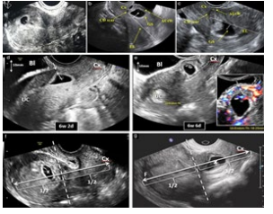  <strong>Figure 4:</strong> Evaluation of site of implantation of pregnancy following previous CD, based on three suggested sonographic markers (aÃ?Â??Ã?Â???Ã?Â??Ã?Â????Ã?Â??Ã?Â???Ã?Â??Ã?Â?????Ã?Â??Ã?Â???Ã?Â??Ã?Â????Ã?Â??Ã?Â???Ã?Â??Ã?Â??????Ã?Â??Ã?Â???Ã?Â??Ã?Â????Ã?Â??Ã?Â???Ã?Â??Ã?Â?????Ã?Â??Ã?Â???Ã?Â??Ã?Â????Ã?Â??Ã?Â???Ã?Â??Ã?Â???????Ã?Â??Ã?Â???Ã?Â??Ã?Â????Ã?Â??Ã?Â???Ã?Â??Ã?Â?????Ã?Â??Ã?Â???Ã?Â??Ã?Â????Ã?Â??Ã?Â???Ã?Â??Ã?Â??????Ã?Â??Ã?Â???Ã?Â??Ã?Â????Ã?Â??Ã?Â???Ã?Â??Ã?Â?????Ã?Â??Ã?Â???Ã?Â??Ã?Â????Ã?Â??Ã?Â???Ã?Â??Ã?Â????????Ã?Â??Ã?Â???Ã?Â??Ã?Â????Ã?Â??Ã?Â???Ã?Â??Ã?Â?????Ã?Â??Ã?Â???Ã?Â??Ã?Â????Ã?Â??Ã?Â???Ã?Â??Ã?Â??????Ã?Â??Ã?Â???Ã?Â??Ã?Â????Ã?Â??Ã?Â???Ã?Â??Ã?Â?????Ã?Â??Ã?Â???Ã?Â??Ã?Â????Ã?Â??Ã?Â???Ã?Â??Ã?Â???????Ã?Â??Ã?Â???Ã?Â??Ã?Â????Ã?Â??Ã?Â???Ã?Â??Ã?Â?????Ã?Â??Ã?Â???Ã?Â??Ã?Â????Ã?Â??Ã?Â???Ã?Â??Ã?Â??????Ã?Â??Ã?Â???Ã?Â??Ã?Â????Ã?Â??Ã?Â???Ã?Â??Ã?Â?????Ã?Â??Ã?Â???Ã?Â??Ã?Â????Ã?Â??Ã?Â???Ã?Â??Ã?Â?????????Ã?Â??Ã?Â???Ã?Â??Ã?Â????Ã?Â??Ã?Â???Ã?Â??Ã?Â?????Ã?Â??Ã?Â???Ã?Â??Ã?Â????Ã?Â??Ã?Â???Ã?Â??Ã?Â??????Ã?Â??Ã?Â???Ã?Â??Ã?Â????Ã?Â??Ã?Â???Ã?Â??Ã?Â?????Ã?Â??Ã?Â???Ã?Â??Ã?Â????Ã?Â??Ã?Â???Ã?Â??Ã?Â???????Ã?Â??Ã?Â???Ã?Â??Ã?Â????Ã?Â??Ã?Â???Ã?Â??Ã?Â?????Ã?Â??Ã?Â???Ã?Â??Ã?Â????Ã?Â??Ã?Â???Ã?Â??Ã?Â??????Ã?Â??Ã?Â???Ã?Â??Ã?Â????Ã?Â??Ã?Â???Ã?Â??Ã?Â?????Ã?Â??Ã?Â???Ã?Â??Ã?Â????Ã?Â??Ã?Â???Ã?Â??Ã?Â????????Ã?Â??Ã?Â???Ã?Â??Ã?Â????Ã?Â??Ã?Â???Ã?Â??Ã?Â?????Ã?Â??Ã?Â???Ã?Â??Ã?Â????Ã?Â??Ã?Â???Ã?Â??Ã?Â??????Ã?Â??Ã?Â???Ã?Â??Ã?Â????Ã?Â??Ã?Â???Ã?Â??Ã?Â?????Ã?Â??Ã?Â???Ã?Â??Ã?Â????Ã?Â??Ã?Â???Ã?Â??Ã?Â???????Ã?Â??Ã?Â???Ã?Â??Ã?Â????Ã?Â??Ã?Â???Ã?Â??Ã?Â?????Ã?Â??Ã?Â???Ã?Â??Ã?Â????Ã?Â??Ã?Â???Ã?Â??Ã?Â??????Ã?Â??Ã?Â???Ã?Â??Ã?Â????Ã?Â??Ã?Â???Ã?Â??Ã?Â?????Ã?Â??Ã?Â???Ã?Â??Ã?Â????Ã?Â??Ã?Â???Ã?Â??Ã?Â????????Ã?Â??Ã?Â???Ã?Â??Ã?Â????Ã?Â??Ã?Â???Ã?Â??Ã?Â?????Ã?Â??Ã?Â???Ã?Â??Ã?Â????Ã?Â??Ã?Â???Ã?Â??Ã?Â??????Ã?Â??Ã?Â???Ã?Â??Ã?Â????Ã?Â??Ã?Â???Ã?Â??Ã?Â?????Ã?Â??Ã?Â???Ã?Â??Ã?Â????Ã?Â??Ã?Â???Ã?Â??Ã?Â???????Ã?Â??Ã?Â???Ã?Â??Ã?Â????Ã?Â??Ã?Â???Ã?Â??Ã?Â?????Ã?Â??Ã?Â???Ã?Â??Ã?Â????Ã?Â??Ã?Â???Ã?Â??Ã?Â??????Ã?Â??Ã?Â???Ã?Â??Ã?Â????Ã?Â??Ã?Â???Ã?Â??Ã?Â?????Ã?Â??Ã?Â???Ã?Â??Ã?Â????Ã?Â??Ã?Â???Ã?Â??Ã?Â????????Ã?Â??Ã?Â???Ã?Â??Ã?Â????Ã?Â??Ã?Â???Ã?Â??Ã?Â?????Ã?Â??Ã?Â???Ã?Â??Ã?Â????Ã?Â??Ã?Â???Ã?Â??Ã?Â??????Ã?Â??Ã?Â???Ã?Â??Ã?Â????Ã?Â??Ã?Â???Ã?Â??Ã?Â?????Ã?Â??Ã?Â???Ã?Â??Ã?Â????Ã?Â??Ã?Â???Ã?Â??Ã?Â???????Ã?Â??Ã?Â???Ã?Â??Ã?Â????Ã?Â??Ã?Â???Ã?Â??Ã?Â?????Ã?Â??Ã?Â???Ã?Â??Ã?Â????Ã?Â??Ã?Â???Ã?Â??Ã?Â??????Ã?Â??Ã?Â???Ã?Â??Ã?Â????Ã?Â??Ã?Â???Ã?Â??Ã?Â?????Ã?Â??Ã?Â???Ã?Â??Ã?Â????Ã?Â??Ã?Â???Ã?Â??Ã?Â???????Ã?Â??Ã?Â???Ã?Â??Ã?Â????Ã?Â??Ã?Â???Ã?Â??Ã?Â?????Ã?Â??Ã?Â???Ã?Â??Ã?Â????Ã?Â??Ã?Â???Ã?Â??Ã?Â??????Ã?Â??Ã?Â???Ã?Â??Ã?Â????Ã?Â??Ã?Â???Ã?Â??Ã?Â?????Ã?Â??Ã?Â???Ã?Â??Ã?Â????Ã?Â??Ã?Â???Ã?Â??Ã?Â???????Ã?Â??Ã?Â???Ã?Â??Ã?Â????Ã?Â??Ã?Â???Ã?Â??Ã?Â?????Ã?Â??Ã?Â???Ã?Â??Ã?Â????Ã?Â??Ã?Â???Ã?Â??Ã?Â??????Ã?Â??Ã?Â???Ã?Â??Ã?Â????Ã?Â??Ã?Â???Ã?Â??Ã?Â?????Ã?Â??Ã?Â???Ã?Â??Ã?Â????Ã?Â??Ã?Â???Ã?Â??Ã?Â??????Ã?Â??Ã?Â???Ã?Â??Ã?Â????Ã?Â??Ã?Â???Ã?Â??Ã?Â?????Ã?Â??Ã?Â???Ã?Â??Ã?Â????Ã?Â??Ã?Â???Ã?Â??Ã?Â??????Ã?Â??Ã?Â???Ã?Â??Ã?Â????Ã?Â??Ã?Â???Ã?Â??Ã?Â?????Ã?Â??Ã?Â???Ã?Â??Ã?Â????Ã?Â??Ã?Â???Ã?Â??Ã?Â?????Ã?Â??Ã?Â???Ã?Â??Ã?Â????Ã?Â??Ã?Â???Ã?Â??Ã?Â?????Ã?Â??Ã?Â???Ã?Â??Ã?Â????Ã?Â??Ã?Â???Ã?Â??Ã?Â????Ã?Â??Ã?Â???Ã?Â??Ã?Â????Ã?Â??Ã?Â???Ã?Â??Ã?Â???Ã?Â??Ã?Â???Ã?Â??Ã?Â??Ã?Â??Ã?Â?Ã?Â¢??c) Ultrasound images showing different types of crossover sign (COS): (a) normal pregnancy, (b) COS-1, (c) COS-2. (d,e). Ultrasound images showing pregnancy implanted on top of well-healed Cesarean section scar (on-the-scar) (d) and into deficient or dehiscent Cesarean section scar (in-the-niche) (e). (f,g) Sagittal consecutive ultrasound images showing implantation of center of gestational sac (X) above (f) and below (g) midpoint of uterus along longitudinal line connecting external cervical os and fundus (F).AUtW, anterior uterine wall (Legend: Bl, bladder; Cx, cervix; EL, endometrial line; GS, gestational sac; UC, uterine cavity) (Adopted from CalÃ?Â??Ã?Â???Ã?Â??Ã?Â????Ã?Â??Ã?Â???Ã?Â??Ã?Â?????Ã?Â??Ã?Â???Ã?Â??Ã?Â????Ã?Â??Ã?Â???Ã?Â??Ã?Â??????Ã?Â??Ã?Â???Ã?Â??Ã?Â????Ã?Â??Ã?Â???Ã?Â??Ã?Â?????Ã?Â??Ã?Â???Ã?Â??Ã?Â????Ã?Â??Ã?Â???Ã?Â??Ã?Â???????Ã?Â??Ã?Â???Ã?Â??Ã?Â????Ã?Â??Ã?Â???Ã?Â??Ã?Â?????Ã?Â??Ã?Â???Ã?Â??Ã?Â????Ã?Â??Ã?Â???Ã?Â??Ã?Â??????Ã?Â??Ã?Â???Ã?Â??Ã?Â????Ã?Â??Ã?Â???Ã?Â??Ã?Â?????Ã?Â??Ã?Â???Ã?Â??Ã?Â????Ã?Â??Ã?Â???Ã?Â??Ã?Â????????Ã?Â??Ã?Â???Ã?Â??Ã?Â????Ã?Â??Ã?Â???Ã?Â??Ã?Â?????Ã?Â??Ã?Â???Ã?Â??Ã?Â????Ã?Â??Ã?Â???Ã?Â??Ã?Â??????Ã?Â??Ã?Â???Ã?Â??Ã?Â????Ã?Â??Ã?Â???Ã?Â??Ã?Â?????Ã?Â??Ã?Â???Ã?Â??Ã?Â????Ã?Â??Ã?Â???Ã?Â??Ã?Â???????Ã?Â??Ã?Â???Ã?Â??Ã?Â????Ã?Â??Ã?Â???Ã?Â??Ã?Â?????Ã?Â??Ã?Â???Ã?Â??Ã?Â????Ã?Â??Ã?Â???Ã?Â??Ã?Â??????Ã?Â??Ã?Â???Ã?Â??Ã?Â????Ã?Â??Ã?Â???Ã?Â??Ã?Â?????Ã?Â??Ã?Â???Ã?Â??Ã?Â????Ã?Â??Ã?Â???Ã?Â??Ã?Â?????????Ã?Â??Ã?Â???Ã?Â??Ã?Â????Ã?Â??Ã?Â???Ã?Â??Ã?Â?????Ã?Â??Ã?Â???Ã?Â??Ã?Â????Ã?Â??Ã?Â???Ã?Â??Ã?Â??????Ã?Â??Ã?Â???Ã?Â??Ã?Â????Ã?Â??Ã?Â???Ã?Â??Ã?Â?????Ã?Â??Ã?Â???Ã?Â??Ã?Â????Ã?Â??Ã?Â???Ã?Â??Ã?Â???????Ã?Â??Ã?Â???Ã?Â??Ã?Â????Ã?Â??Ã?Â???Ã?Â??Ã?Â?????Ã?Â??Ã?Â???Ã?Â??Ã?Â????Ã?Â??Ã?Â???Ã?Â??Ã?Â??????Ã?Â??Ã?Â???Ã?Â??Ã?Â????Ã?Â??Ã?Â???Ã?Â??Ã?Â?????Ã?Â??Ã?Â???Ã?Â??Ã?Â????Ã?Â??Ã?Â???Ã?Â??Ã?Â????????Ã?Â??Ã?Â???Ã?Â??Ã?Â????Ã?Â??Ã?Â???Ã?Â??Ã?Â?????Ã?Â??Ã?Â???Ã?Â??Ã?Â????Ã?Â??Ã?Â???Ã?Â??Ã?Â??????Ã?Â??Ã?Â???Ã?Â??Ã?Â????Ã?Â??Ã?Â???Ã?Â??Ã?Â?????Ã?Â??Ã?Â???Ã?Â??Ã?Â????Ã?Â??Ã?Â???Ã?Â??Ã?Â???????Ã?Â??Ã?Â???Ã?Â??Ã?Â????Ã?Â??Ã?Â???Ã?Â??Ã?Â?????Ã?Â??Ã?Â???Ã?Â??Ã?Â????Ã?Â??Ã?Â???Ã?Â??Ã?Â??????Ã?Â??Ã?Â???Ã?Â??Ã?Â????Ã?Â??Ã?Â???Ã?Â??Ã?Â?????Ã?Â??Ã?Â???Ã?Â??Ã?Â????Ã?Â??Ã?Â???Ã?Â??Ã?Â?????????Ã?Â??Ã?Â???Ã?Â??Ã?Â????Ã?Â??Ã?Â???Ã?Â??Ã?Â?????Ã?Â??Ã?Â???Ã?Â??Ã?Â????Ã?Â??Ã?Â???Ã?Â??Ã?Â??????Ã?Â??Ã?Â???Ã?Â??Ã?Â????Ã?Â??Ã?Â???Ã?Â??Ã?Â?????Ã?Â??Ã?Â???Ã?Â??Ã?Â????Ã?Â??Ã?Â???Ã?Â??Ã?Â???????Ã?Â??Ã?Â???Ã?Â??Ã?Â????Ã?Â??Ã?Â???Ã?Â??Ã?Â?????Ã?Â??Ã?Â???Ã?Â??Ã?Â????Ã?Â??Ã?Â???Ã?Â??Ã?Â??????Ã?Â??Ã?Â???Ã?Â??Ã?Â????Ã?Â??Ã?Â???Ã?Â??Ã?Â?????Ã?Â??Ã?Â???Ã?Â??Ã?Â????Ã?Â??Ã?Â???Ã?Â??Ã?Â????????Ã?Â??Ã?Â???Ã?Â??Ã?Â????Ã?Â??Ã?Â???Ã?Â??Ã?Â?????Ã?Â??Ã?Â???Ã?Â??Ã?Â????Ã?Â??Ã?Â???Ã?Â??Ã?Â??????Ã?Â??Ã?Â???Ã?Â??Ã?Â????Ã?Â??Ã?Â???Ã?Â??Ã?Â?????Ã?Â??Ã?Â???Ã?Â??Ã?Â????Ã?Â??Ã?Â???Ã?Â??Ã?Â???????Ã?Â??Ã?Â???Ã?Â??Ã?Â????Ã?Â??Ã?Â???Ã?Â??Ã?Â?????Ã?Â??Ã?Â???Ã?Â??Ã?Â????Ã?Â??Ã?Â???Ã?Â??Ã?Â??????Ã?Â??Ã?Â???Ã?Â??Ã?Â????Ã?Â??Ã?Â???Ã?Â??Ã?Â?????Ã?Â??Ã?Â???Ã?Â??Ã?Â????Ã?Â??Ã?Â???Ã?Â??Ã?Â?????????Ã?Â??Ã?Â???Ã?Â??Ã?Â????Ã?Â??Ã?Â???Ã?Â??Ã?Â?????Ã?Â??Ã?Â???Ã?Â??Ã?Â????Ã?Â??Ã?Â???Ã?Â??Ã?Â??????Ã?Â??Ã?Â???Ã?Â??Ã?Â????Ã?Â??Ã?Â???Ã?Â??Ã?Â?????Ã?Â??Ã?Â???Ã?Â??Ã?Â????Ã?Â??Ã?Â???Ã?Â??Ã?Â???????Ã?Â??Ã?Â???Ã?Â??Ã?Â????Ã?Â??Ã?Â???Ã?Â??Ã?Â?????Ã?Â??Ã?Â???Ã?Â??Ã?Â????Ã?Â??Ã?Â???Ã?Â??Ã?Â??????Ã?Â??Ã?Â???Ã?Â??Ã?Â????Ã?Â??Ã?Â???Ã?Â??Ã?Â?????Ã?Â??Ã?Â???Ã?Â??Ã?Â????Ã?Â??Ã?Â???Ã?Â??Ã?Â????????Ã?Â??Ã?Â???Ã?Â??Ã?Â????Ã?Â??Ã?Â???Ã?Â??Ã?Â?????Ã?Â??Ã?Â???Ã?Â??Ã?Â????Ã?Â??Ã?Â???Ã?Â??Ã?Â??????Ã?Â??Ã?Â???Ã?Â??Ã?Â????Ã?Â??Ã?Â???Ã?Â??Ã?Â?????Ã?Â??Ã?Â???Ã?Â??Ã?Â????Ã?Â??Ã?Â???Ã?Â??Ã?Â???????Ã?Â??Ã?Â???Ã?Â??Ã?Â????Ã?Â??Ã?Â???Ã?Â??Ã?Â?????Ã?Â??Ã?Â???Ã?Â??Ã?Â????Ã?Â??Ã?Â???Ã?Â??Ã?Â??????Ã?Â??Ã?Â???Ã?Â??Ã?Â????Ã?Â??Ã?Â???Ã?Â??Ã?Â?????Ã?Â??Ã?Â???Ã?Â??Ã?Â????Ã?Â??Ã?Â???Ã?Â??Ã?Â????????Ã?Â??Ã?Â???Ã?Â??Ã?Â????Ã?Â??Ã?Â???Ã?Â??Ã?Â?????Ã?Â??Ã?Â???Ã?Â??Ã?Â????Ã?Â??Ã?Â???Ã?Â??Ã?Â??????Ã?Â??Ã?Â???Ã?Â??Ã?Â????Ã?Â??Ã?Â???Ã?Â??Ã?Â?????Ã?Â??Ã?Â???Ã?Â??Ã?Â????Ã?Â??Ã?Â???Ã?Â??Ã?Â???????Ã?Â??Ã?Â???Ã?Â??Ã?Â????Ã?Â??Ã?Â???Ã?Â??Ã?Â?????Ã?Â??Ã?Â???Ã?Â??Ã?Â????Ã?Â??Ã?Â???Ã?Â??Ã?Â??????Ã?Â??Ã?Â???Ã?Â??Ã?Â????Ã?Â??Ã?Â???Ã?Â??Ã?Â?????Ã?Â??Ã?Â???Ã?Â??Ã?Â????Ã?Â??Ã?Â???Ã?Â??Ã?Â????????Ã?Â??Ã?Â???Ã?Â??Ã?Â????Ã?Â??Ã?Â???Ã?Â??Ã?Â?????Ã?Â??Ã?Â???Ã?Â??Ã?Â????Ã?Â??Ã?Â???Ã?Â??Ã?Â??????Ã?Â??Ã?Â???Ã?Â??Ã?Â????Ã?Â??Ã?Â???Ã?Â??Ã?Â?????Ã?Â??Ã?Â???Ã?Â??Ã?Â????Ã?Â??Ã?Â???Ã?Â??Ã?Â???????Ã?Â??Ã?Â???Ã?Â??Ã?Â????Ã?Â??Ã?Â???Ã?Â??Ã?Â?????Ã?Â??Ã?Â???Ã?Â??Ã?Â????Ã?Â??Ã?Â???Ã?Â??Ã?Â??????Ã?Â??Ã?Â???Ã?Â??Ã?Â????Ã?Â??Ã?Â???Ã?Â??Ã?Â?????Ã?Â??Ã?Â???Ã?Â??Ã?Â????Ã?Â??Ã?Â???Ã?Â??Ã?Â???????Ã?Â??Ã?Â???Ã?Â??Ã?Â????Ã?Â??Ã?Â???Ã?Â??Ã?Â?????Ã?Â??Ã?Â???Ã?Â??Ã?Â????Ã?Â??Ã?Â???Ã?Â??Ã?Â??????Ã?Â??Ã?Â???Ã?Â??Ã?Â????Ã?Â??Ã?Â???Ã?Â??Ã?Â?????Ã?Â??Ã?Â???Ã?Â??Ã?Â????Ã?Â??Ã?Â???Ã?Â??Ã?Â???????Ã?Â??Ã?Â???Ã?Â??Ã?Â????Ã?Â??Ã?Â???Ã?Â??Ã?Â?????Ã?Â??Ã?Â???Ã?Â??Ã?Â????Ã?Â??Ã?Â???Ã?Â??Ã?Â??????Ã?Â??Ã?Â???Ã?Â??Ã?Â????Ã?Â??Ã?Â???Ã?Â??Ã?Â?????Ã?Â??Ã?Â???Ã?Â??Ã?Â????Ã?Â??Ã?Â???Ã?Â??Ã?Â??????Ã?Â??Ã?Â???Ã?Â??Ã?Â????Ã?Â??Ã?Â???Ã?Â??Ã?Â?????Ã?Â??Ã?Â???Ã?Â??Ã?Â????Ã?Â??Ã?Â???Ã?Â??Ã?Â??????Ã?Â??Ã?Â???Ã?Â??Ã?Â????Ã?Â??Ã?Â???Ã?Â??Ã?Â?????Ã?Â??Ã?Â???Ã?Â??Ã?Â????Ã?Â??Ã?Â???Ã?Â??Ã?Â?????Ã?Â??Ã?Â???Ã?Â??Ã?Â????Ã?Â??Ã?Â???Ã?Â??Ã?Â?????Ã?Â??Ã?Â???Ã?Â??Ã?Â????Ã?Â??Ã?Â???Ã?Â??Ã?Â????Ã?Â??Ã?Â???Ã?Â??Ã?Â????Ã?Â??Ã?Â???Ã?Â??Ã?Â???Ã?Â??Ã?Â???Ã?Â??Ã?Â??Ã?Â??Ã?Â?Ã?Â­ G, et al. 2020 [71]).