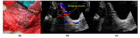 <strong>Figure 6</strong>: Demonstrating the neovascularity seen at laparotomy (a), bridging vessels with color Doppler ultrasound (b) and as bladder wall interruption (c). (a) Demonstrating the massive neovascularity seen at laparotomy between the anterior aspect of the uterus and the posterior bladder. (b) Demonstrating the same vessels as in (a) seen as Ã?Â??Ã?Â???Ã?Â??Ã?Â????Ã?Â??Ã?Â???Ã?Â??Ã?Â?????Ã?Â??Ã?Â???Ã?Â??Ã?Â????Ã?Â??Ã?Â???Ã?Â??Ã?Â??????Ã?Â??Ã?Â???Ã?Â??Ã?Â????Ã?Â??Ã?Â???Ã?Â??Ã?Â?????Ã?Â??Ã?Â???Ã?Â??Ã?Â????Ã?Â??Ã?Â???Ã?Â??Ã?Â???????Ã?Â??Ã?Â???Ã?Â??Ã?Â????Ã?Â??Ã?Â???Ã?Â??Ã?Â?????Ã?Â??Ã?Â???Ã?Â??Ã?Â????Ã?Â??Ã?Â???Ã?Â??Ã?Â??????Ã?Â??Ã?Â???Ã?Â??Ã?Â????Ã?Â??Ã?Â???Ã?Â??Ã?Â?????Ã?Â??Ã?Â???Ã?Â??Ã?Â????Ã?Â??Ã?Â???Ã?Â??Ã?Â????????Ã?Â??Ã?Â???Ã?Â??Ã?Â????Ã?Â??Ã?Â???Ã?Â??Ã?Â?????Ã?Â??Ã?Â???Ã?Â??Ã?Â????Ã?Â??Ã?Â???Ã?Â??Ã?Â??????Ã?Â??Ã?Â???Ã?Â??Ã?Â????Ã?Â??Ã?Â???Ã?Â??Ã?Â?????Ã?Â??Ã?Â???Ã?Â??Ã?Â????Ã?Â??Ã?Â???Ã?Â??Ã?Â???????Ã?Â??Ã?Â???Ã?Â??Ã?Â????Ã?Â??Ã?Â???Ã?Â??Ã?Â?????Ã?Â??Ã?Â???Ã?Â??Ã?Â????Ã?Â??Ã?Â???Ã?Â??Ã?Â??????Ã?Â??Ã?Â???Ã?Â??Ã?Â????Ã?Â??Ã?Â???Ã?Â??Ã?Â?????Ã?Â??Ã?Â???Ã?Â??Ã?Â????Ã?Â??Ã?Â???Ã?Â??Ã?Â?????????Ã?Â??Ã?Â???Ã?Â??Ã?Â????Ã?Â??Ã?Â???Ã?Â??Ã?Â?????Ã?Â??Ã?Â???Ã?Â??Ã?Â????Ã?Â??Ã?Â???Ã?Â??Ã?Â??????Ã?Â??Ã?Â???Ã?Â??Ã?Â????Ã?Â??Ã?Â???Ã?Â??Ã?Â?????Ã?Â??Ã?Â???Ã?Â??Ã?Â????Ã?Â??Ã?Â???Ã?Â??Ã?Â???????Ã?Â??Ã?Â???Ã?Â??Ã?Â????Ã?Â??Ã?Â???Ã?Â??Ã?Â?????Ã?Â??Ã?Â???Ã?Â??Ã?Â????Ã?Â??Ã?Â???Ã?Â??Ã?Â??????Ã?Â??Ã?Â???Ã?Â??Ã?Â????Ã?Â??Ã?Â???Ã?Â??Ã?Â?????Ã?Â??Ã?Â???Ã?Â??Ã?Â????Ã?Â??Ã?Â???Ã?Â??Ã?Â????????Ã?Â??Ã?Â???Ã?Â??Ã?Â????Ã?Â??Ã?Â???Ã?Â??Ã?Â?????Ã?Â??Ã?Â???Ã?Â??Ã?Â????Ã?Â??Ã?Â???Ã?Â??Ã?Â??????Ã?Â??Ã?Â???Ã?Â??Ã?Â????Ã?Â??Ã?Â???Ã?Â??Ã?Â?????Ã?Â??Ã?Â???Ã?Â??Ã?Â????Ã?Â??Ã?Â???Ã?Â??Ã?Â???????Ã?Â??Ã?Â???Ã?Â??Ã?Â????Ã?Â??Ã?Â???Ã?Â??Ã?Â?????Ã?Â??Ã?Â???Ã?Â??Ã?Â????Ã?Â??Ã?Â???Ã?Â??Ã?Â??????Ã?Â??Ã?Â???Ã?Â??Ã?Â????Ã?Â??Ã?Â???Ã?Â??Ã?Â?????Ã?Â??Ã?Â???Ã?Â??Ã?Â????Ã?Â??Ã?Â???Ã?Â??Ã?Â????????Ã?Â??Ã?Â???Ã?Â??Ã?Â????Ã?Â??Ã?Â???Ã?Â??Ã?Â?????Ã?Â??Ã?Â???Ã?Â??Ã?Â????Ã?Â??Ã?Â???Ã?Â??Ã?Â??????Ã?Â??Ã?Â???Ã?Â??Ã?Â????Ã?Â??Ã?Â???Ã?Â??Ã?Â?????Ã?Â??Ã?Â???Ã?Â??Ã?Â????Ã?Â??Ã?Â???Ã?Â??Ã?Â???????Ã?Â??Ã?Â???Ã?Â??Ã?Â????Ã?Â??Ã?Â???Ã?Â??Ã?Â?????Ã?Â??Ã?Â???Ã?Â??Ã?Â????Ã?Â??Ã?Â???Ã?Â??Ã?Â??????Ã?Â??Ã?Â???Ã?Â??Ã?Â????Ã?Â??Ã?Â???Ã?Â??Ã?Â?????Ã?Â??Ã?Â???Ã?Â??Ã?Â????Ã?Â??Ã?Â???Ã?Â??Ã?Â????????Ã?Â??Ã?Â???Ã?Â??Ã?Â????Ã?Â??Ã?Â???Ã?Â??Ã?Â?????Ã?Â??Ã?Â???Ã?Â??Ã?Â????Ã?Â??Ã?Â???Ã?Â??Ã?Â??????Ã?Â??Ã?Â???Ã?Â??Ã?Â????Ã?Â??Ã?Â???Ã?Â??Ã?Â?????Ã?Â??Ã?Â???Ã?Â??Ã?Â????Ã?Â??Ã?Â???Ã?Â??Ã?Â???????Ã?Â??Ã?Â???Ã?Â??Ã?Â????Ã?Â??Ã?Â???Ã?Â??Ã?Â?????Ã?Â??Ã?Â???Ã?Â??Ã?Â????Ã?Â??Ã?Â???Ã?Â??Ã?Â??????Ã?Â??Ã?Â???Ã?Â??Ã?Â????Ã?Â??Ã?Â???Ã?Â??Ã?Â?????Ã?Â??Ã?Â???Ã?Â??Ã?Â????Ã?Â??Ã?Â???Ã?Â??Ã?Â???????Ã?Â??Ã?Â???Ã?Â??Ã?Â????Ã?Â??Ã?Â???Ã?Â??Ã?Â?????Ã?Â??Ã?Â???Ã?Â??Ã?Â????Ã?Â??Ã?Â???Ã?Â??Ã?Â??????Ã?Â??Ã?Â???Ã?Â??Ã?Â????Ã?Â??Ã?Â???Ã?Â??Ã?Â?????Ã?Â??Ã?Â???Ã?Â??Ã?Â????Ã?Â??Ã?Â???Ã?Â??Ã?Â???????Ã?Â??Ã?Â???Ã?Â??Ã?Â????Ã?Â??Ã?Â???Ã?Â??Ã?Â?????Ã?Â??Ã?Â???Ã?Â??Ã?Â????Ã?Â??Ã?Â???Ã?Â??Ã?Â??????Ã?Â??Ã?Â???Ã?Â??Ã?Â????Ã?Â??Ã?Â???Ã?Â??Ã?Â?????Ã?Â??Ã?Â???Ã?Â??Ã?Â????Ã?Â??Ã?Â???Ã?Â??Ã?Â??????Ã?Â??Ã?Â???Ã?Â??Ã?Â????Ã?Â??Ã?Â???Ã?Â??Ã?Â?????Ã?Â??Ã?Â???Ã?Â??Ã?Â????Ã?Â??Ã?Â???Ã?Â??Ã?Â??????Ã?Â??Ã?Â???Ã?Â??Ã?Â????Ã?Â??Ã?Â???Ã?Â??Ã?Â?????Ã?Â??Ã?Â???Ã?Â??Ã?Â????Ã?Â??Ã?Â???Ã?Â??Ã?Â?????Ã?Â??Ã?Â???Ã?Â??Ã?Â????Ã?Â??Ã?Â???Ã?Â??Ã?Â?????Ã?Â??Ã?Â???Ã?Â??Ã?Â????Ã?Â??Ã?Â???Ã?Â??Ã?Â????Ã?Â??Ã?Â???Ã?Â??Ã?Â????Ã?Â??Ã?Â???Ã?Â??Ã?Â???Ã?Â??Ã?Â???Ã?Â??Ã?Â??Ã?Â??Ã?Â?Ã?Â¢??bridging vesselsÃ?Â??Ã?Â???Ã?Â??Ã?Â????Ã?Â??Ã?Â???Ã?Â??Ã?Â?????Ã?Â??Ã?Â???Ã?Â??Ã?Â????Ã?Â??Ã?Â???Ã?Â??Ã?Â??????Ã?Â??Ã?Â???Ã?Â??Ã?Â????Ã?Â??Ã?Â???Ã?Â??Ã?Â?????Ã?Â??Ã?Â???Ã?Â??Ã?Â????Ã?Â??Ã?Â???Ã?Â??Ã?Â???????Ã?Â??Ã?Â???Ã?Â??Ã?Â????Ã?Â??Ã?Â???Ã?Â??Ã?Â?????Ã?Â??Ã?Â???Ã?Â??Ã?Â????Ã?Â??Ã?Â???Ã?Â??Ã?Â??????Ã?Â??Ã?Â???Ã?Â??Ã?Â????Ã?Â??Ã?Â???Ã?Â??Ã?Â?????Ã?Â??Ã?Â???Ã?Â??Ã?Â????Ã?Â??Ã?Â???Ã?Â??Ã?Â????????Ã?Â??Ã?Â???Ã?Â??Ã?Â????Ã?Â??Ã?Â???Ã?Â??Ã?Â?????Ã?Â??Ã?Â???Ã?Â??Ã?Â????Ã?Â??Ã?Â???Ã?Â??Ã?Â??????Ã?Â??Ã?Â???Ã?Â??Ã?Â????Ã?Â??Ã?Â???Ã?Â??Ã?Â?????Ã?Â??Ã?Â???Ã?Â??Ã?Â????Ã?Â??Ã?Â???Ã?Â??Ã?Â???????Ã?Â??Ã?Â???Ã?Â??Ã?Â????Ã?Â??Ã?Â???Ã?Â??Ã?Â?????Ã?Â??Ã?Â???Ã?Â??Ã?Â????Ã?Â??Ã?Â???Ã?Â??Ã?Â??????Ã?Â??Ã?Â???Ã?Â??Ã?Â????Ã?Â??Ã?Â???Ã?Â??Ã?Â?????Ã?Â??Ã?Â???Ã?Â??Ã?Â????Ã?Â??Ã?Â???Ã?Â??Ã?Â?????????Ã?Â??Ã?Â???Ã?Â??Ã?Â????Ã?Â??Ã?Â???Ã?Â??Ã?Â?????Ã?Â??Ã?Â???Ã?Â??Ã?Â????Ã?Â??Ã?Â???Ã?Â??Ã?Â??????Ã?Â??Ã?Â???Ã?Â??Ã?Â????Ã?Â??Ã?Â???Ã?Â??Ã?Â?????Ã?Â??Ã?Â???Ã?Â??Ã?Â????Ã?Â??Ã?Â???Ã?Â??Ã?Â???????Ã?Â??Ã?Â???Ã?Â??Ã?Â????Ã?Â??Ã?Â???Ã?Â??Ã?Â?????Ã?Â??Ã?Â???Ã?Â??Ã?Â????Ã?Â??Ã?Â???Ã?Â??Ã?Â??????Ã?Â??Ã?Â???Ã?Â??Ã?Â????Ã?Â??Ã?Â???Ã?Â??Ã?Â?????Ã?Â??Ã?Â???Ã?Â??Ã?Â????Ã?Â??Ã?Â???Ã?Â??Ã?Â????????Ã?Â??Ã?Â???Ã?Â??Ã?Â????Ã?Â??Ã?Â???Ã?Â??Ã?Â?????Ã?Â??Ã?Â???Ã?Â??Ã?Â????Ã?Â??Ã?Â???Ã?Â??Ã?Â??????Ã?Â??Ã?Â???Ã?Â??Ã?Â????Ã?Â??Ã?Â???Ã?Â??Ã?Â?????Ã?Â??Ã?Â???Ã?Â??Ã?Â????Ã?Â??Ã?Â???Ã?Â??Ã?Â???????Ã?Â??Ã?Â???Ã?Â??Ã?Â????Ã?Â??Ã?Â???Ã?Â??Ã?Â?????Ã?Â??Ã?Â???Ã?Â??Ã?Â????Ã?Â??Ã?Â???Ã?Â??Ã?Â??????Ã?Â??Ã?Â???Ã?Â??Ã?Â????Ã?Â??Ã?Â???Ã?Â??Ã?Â?????Ã?Â??Ã?Â???Ã?Â??Ã?Â????Ã?Â??Ã?Â???Ã?Â??Ã?Â????????Ã?Â??Ã?Â???Ã?Â??Ã?Â????Ã?Â??Ã?Â???Ã?Â??Ã?Â?????Ã?Â??Ã?Â???Ã?Â??Ã?Â????Ã?Â??Ã?Â???Ã?Â??Ã?Â??????Ã?Â??Ã?Â???Ã?Â??Ã?Â????Ã?Â??Ã?Â???Ã?Â??Ã?Â?????Ã?Â??Ã?Â???Ã?Â??Ã?Â????Ã?Â??Ã?Â???Ã?Â??Ã?Â???????Ã?Â??Ã?Â???Ã?Â??Ã?Â????Ã?Â??Ã?Â???Ã?Â??Ã?Â?????Ã?Â??Ã?Â???Ã?Â??Ã?Â????Ã?Â??Ã?Â???Ã?Â??Ã?Â??????Ã?Â??Ã?Â???Ã?Â??Ã?Â????Ã?Â??Ã?Â???Ã?Â??Ã?Â?????Ã?Â??Ã?Â???Ã?Â??Ã?Â????Ã?Â??Ã?Â???Ã?Â??Ã?Â????????Ã?Â??Ã?Â???Ã?Â??Ã?Â????Ã?Â??Ã?Â???Ã?Â??Ã?Â?????Ã?Â??Ã?Â???Ã?Â??Ã?Â????Ã?Â??Ã?Â???Ã?Â??Ã?Â??????Ã?Â??Ã?Â???Ã?Â??Ã?Â????Ã?Â??Ã?Â???Ã?Â??Ã?Â?????Ã?Â??Ã?Â???Ã?Â??Ã?Â????Ã?Â??Ã?Â???Ã?Â??Ã?Â???????Ã?Â??Ã?Â???Ã?Â??Ã?Â????Ã?Â??Ã?Â???Ã?Â??Ã?Â?????Ã?Â??Ã?Â???Ã?Â??Ã?Â????Ã?Â??Ã?Â???Ã?Â??Ã?Â??????Ã?Â??Ã?Â???Ã?Â??Ã?Â????Ã?Â??Ã?Â???Ã?Â??Ã?Â?????Ã?Â??Ã?Â???Ã?Â??Ã?Â????Ã?Â??Ã?Â???Ã?Â??Ã?Â???????Ã?Â??Ã?Â???Ã?Â??Ã?Â????Ã?Â??Ã?Â???Ã?Â??Ã?Â?????Ã?Â??Ã?Â???Ã?Â??Ã?Â????Ã?Â??Ã?Â???Ã?Â??Ã?Â??????Ã?Â??Ã?Â???Ã?Â??Ã?Â????Ã?Â??Ã?Â???Ã?Â??Ã?Â?????Ã?Â??Ã?Â???Ã?Â??Ã?Â????Ã?Â??Ã?Â???Ã?Â??Ã?Â???????Ã?Â??Ã?Â???Ã?Â??Ã?Â????Ã?Â??Ã?Â???Ã?Â??Ã?Â?????Ã?Â??Ã?Â???Ã?Â??Ã?Â????Ã?Â??Ã?Â???Ã?Â??Ã?Â??????Ã?Â??Ã?Â???Ã?Â??Ã?Â????Ã?Â??Ã?Â???Ã?Â??Ã?Â?????Ã?Â??Ã?Â???Ã?Â??Ã?Â????Ã?Â??Ã?Â???Ã?Â??Ã?Â??????Ã?Â??Ã?Â???Ã?Â??Ã?Â????Ã?Â??Ã?Â???Ã?Â??Ã?Â?????Ã?Â??Ã?Â???Ã?Â??Ã?Â????Ã?Â??Ã?Â???Ã?Â??Ã?Â??????Ã?Â??Ã?Â???Ã?Â??Ã?Â????Ã?Â??Ã?Â???Ã?Â??Ã?Â?????Ã?Â??Ã?Â???Ã?Â??Ã?Â????Ã?Â??Ã?Â???Ã?Â??Ã?Â?????Ã?Â??Ã?Â???Ã?Â??Ã?Â????Ã?Â??Ã?Â???Ã?Â??Ã?Â?????Ã?Â??Ã?Â???Ã?Â??Ã?Â????Ã?Â??Ã?Â???Ã?Â??Ã?Â????Ã?Â??Ã?Â???Ã?Â??Ã?Â????Ã?Â??Ã?Â???Ã?Â??Ã?Â???Ã?Â??Ã?Â???Ã?Â??Ã?Â??Ã?Â??Ã?Â?Ã?Â¢?? with color Doppler ultrasound. (c) Demonstrating the same vessels as in (a) seen as bladder wall interruption with gray-scale ultrasound. (Adopted from: Adu-Bredu TK, et al. 2023 [82]).