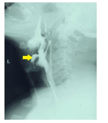 Figure 1: X-ray lateral neck Sharp cervical osteophytes at the levels of C4 and C5 are shown by the yellow arrow 