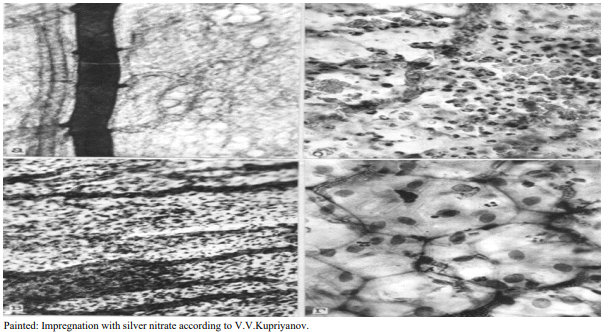 Figure 3: Microvasculatory bed of the pancreas 24 hours after modeling acute pancreatitis. A) Contrasting masses of indigocarmine fill the collecting lymhatic vessels: B) Zone of necrosis and necrobiosis, destruction of hemocapillaries and hemorrhage into crumbling pancreas; C) Microthrombosis of the collecting vein, occlusion of lymphcapillaries with tissue detritus; D) The intercellular spaces of most mesotheliocytes are impregnated with silver nitrate<span style