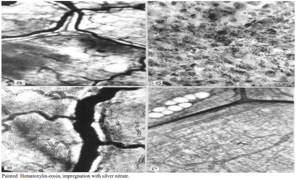 Figure 4: Microvasculatory bed of the pancreas 48 hours after modeling acute pancreatitis. A) Some of the lymphcapillaries are filled with indigocarmine, other microvessels are free from contrast agent. B) A focus of destruction, which in addition to destroyed and half-destroyed cells contains numerous formed elements from the lumen of the hemocapillaries, the wall of which is lysed and destroyed; C) Indigocarmine fills the collecting lymphatic vessel; D) Only part of the blood and lymphatic capillaries preserves their micrometric parameters